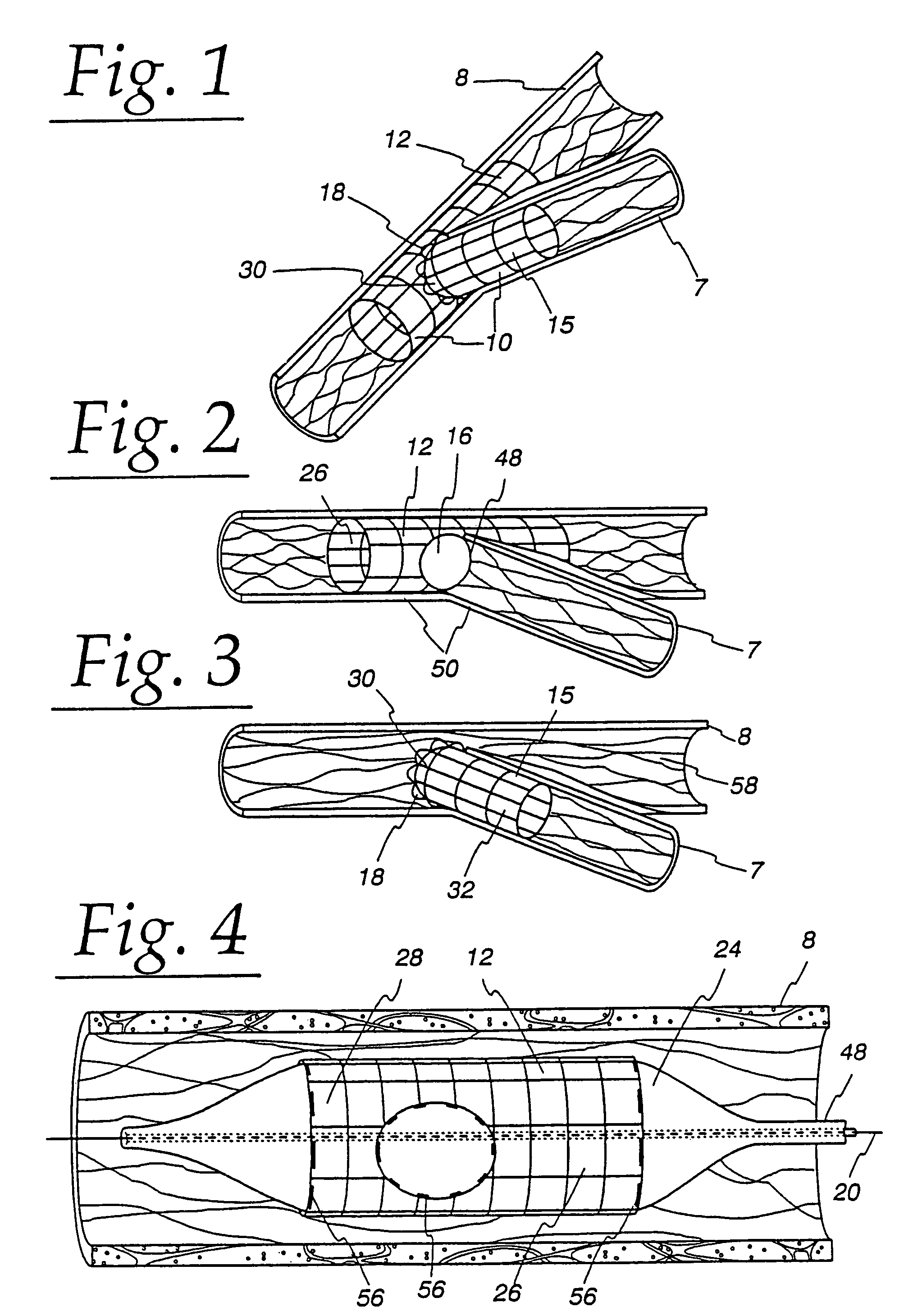 Extendible stent apparatus