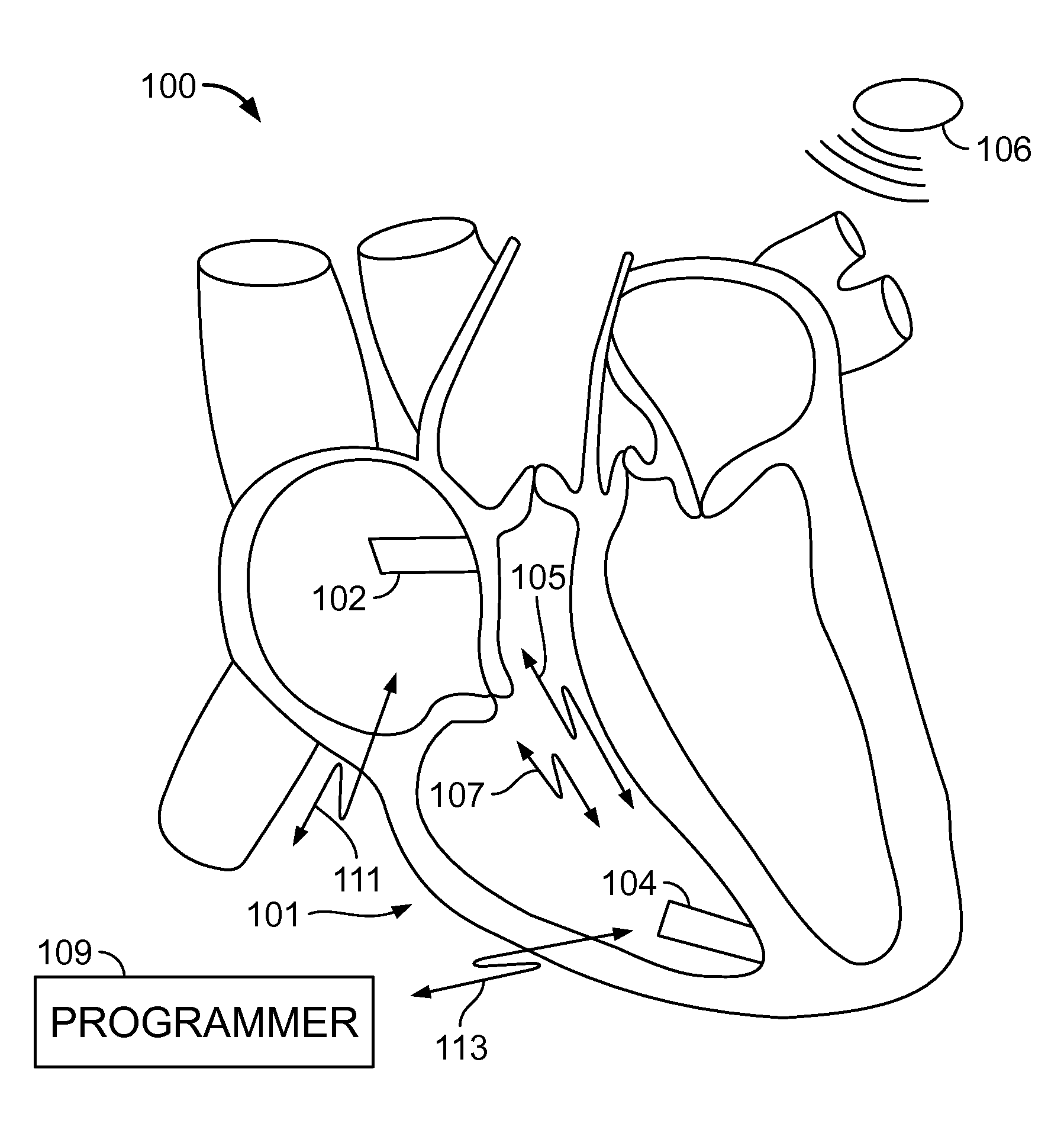 Leadless dual-chamber pacing system and method