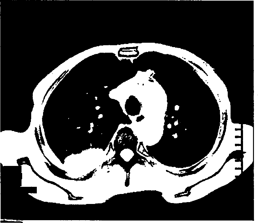 Automatic generating method for colour multi-window CT image