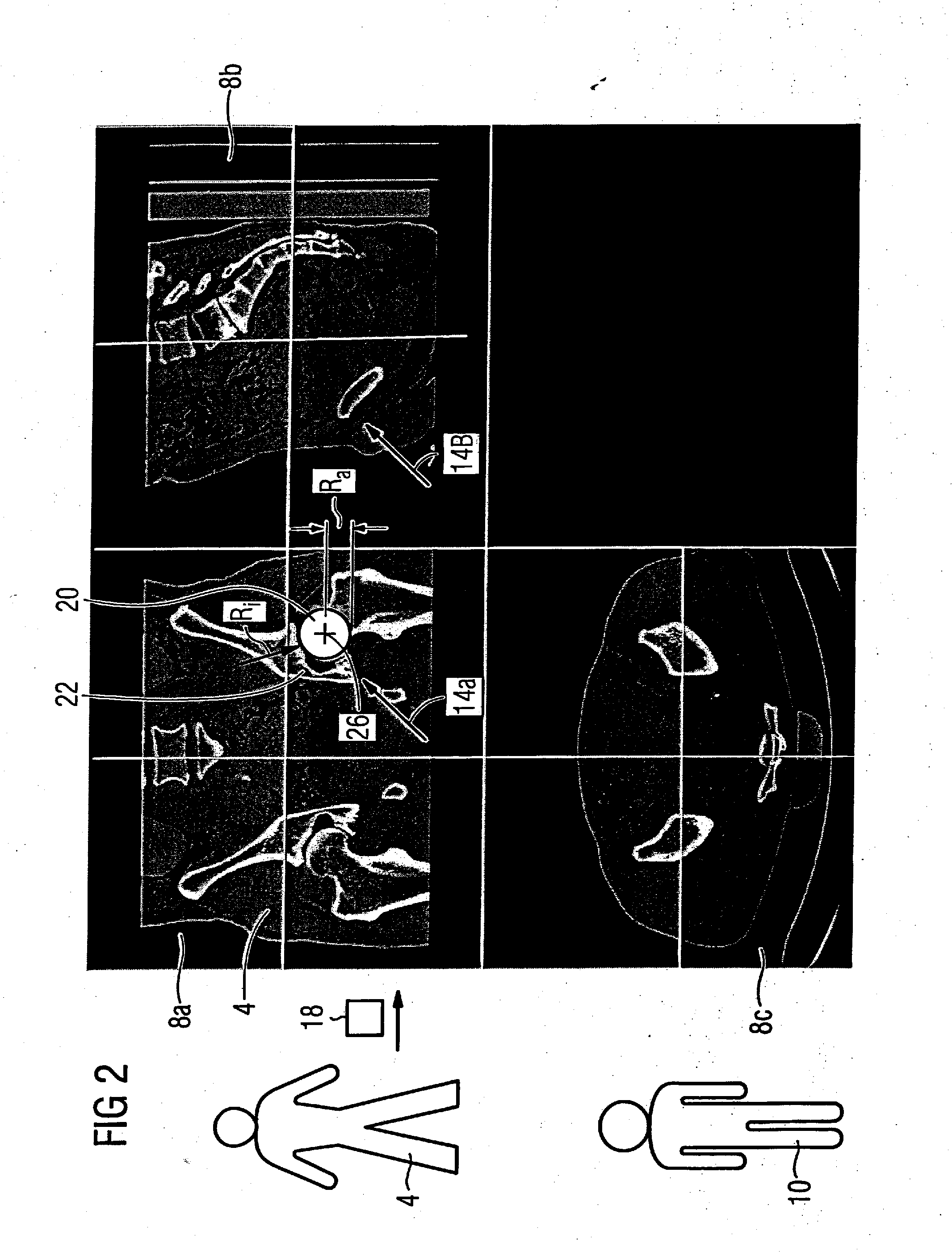 Method for virtual adaptation of an implant to a body part of a patient