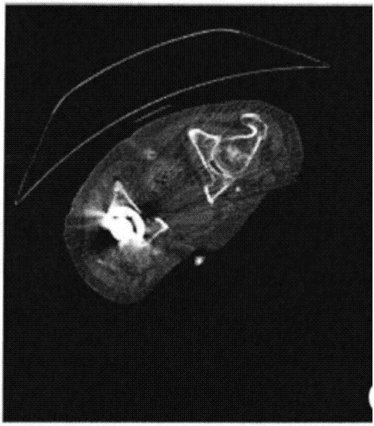 CBCT image ring-like false shadow removing method