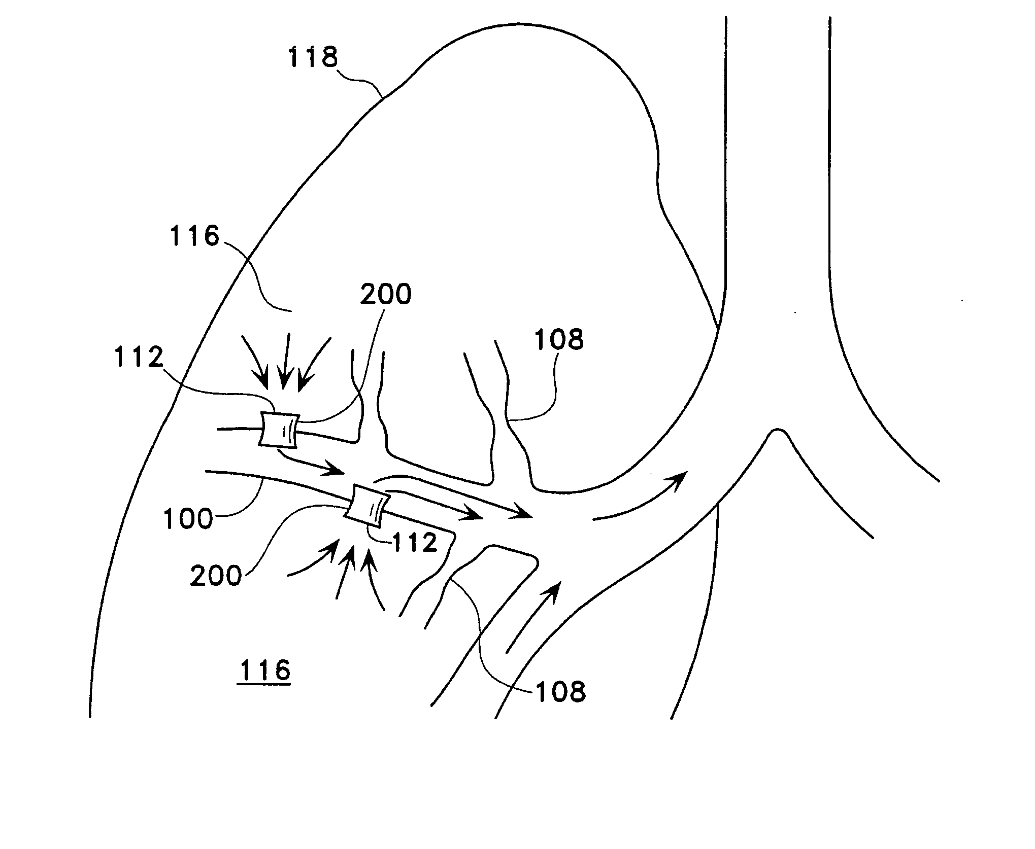 Methods of treating chronic obstructive pulmonary disease