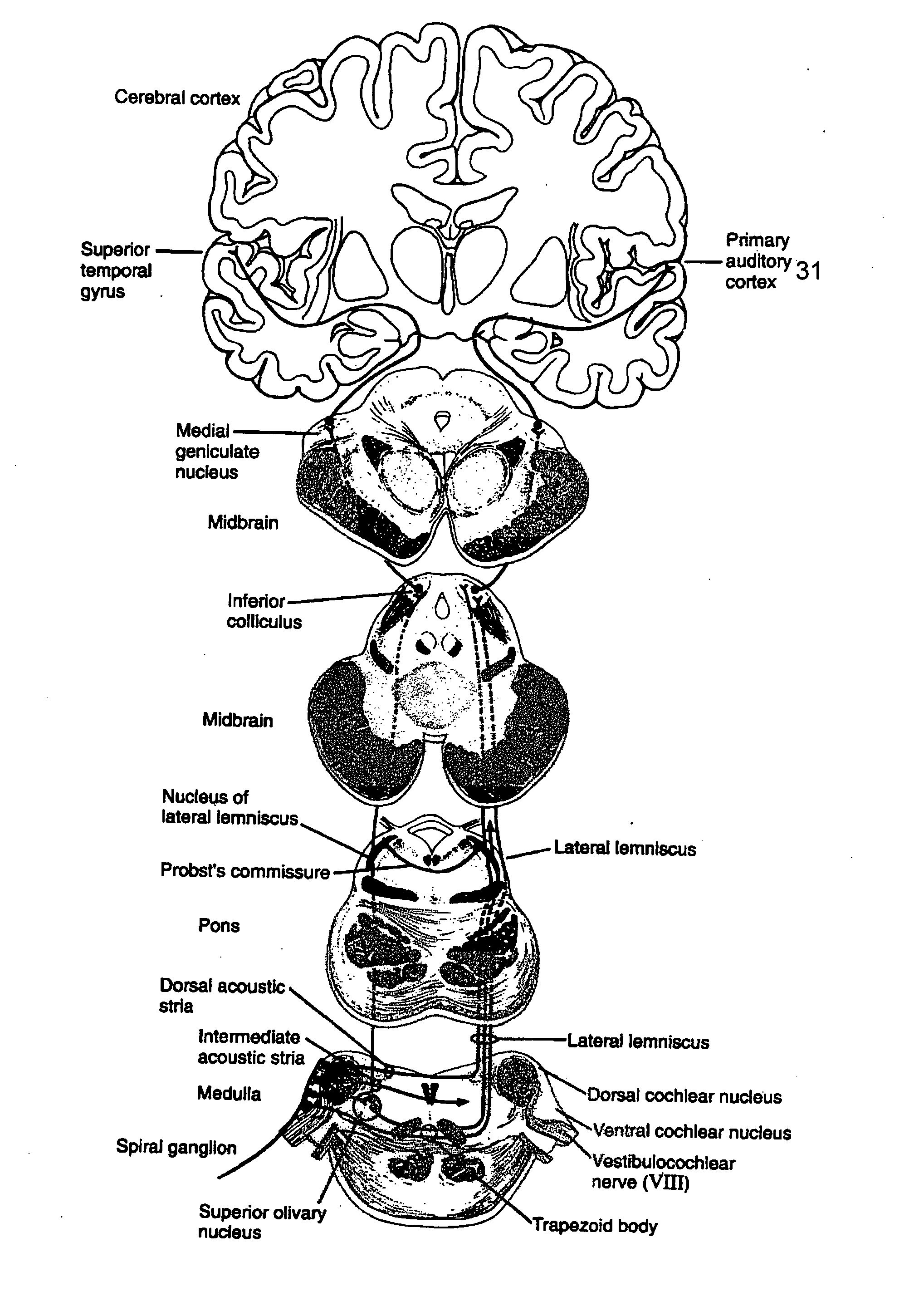 Method and system for cortical stimulation to provide adjunct (ADD-ON) therapy for stroke, tinnitus and other medical disorders using implantable and external components