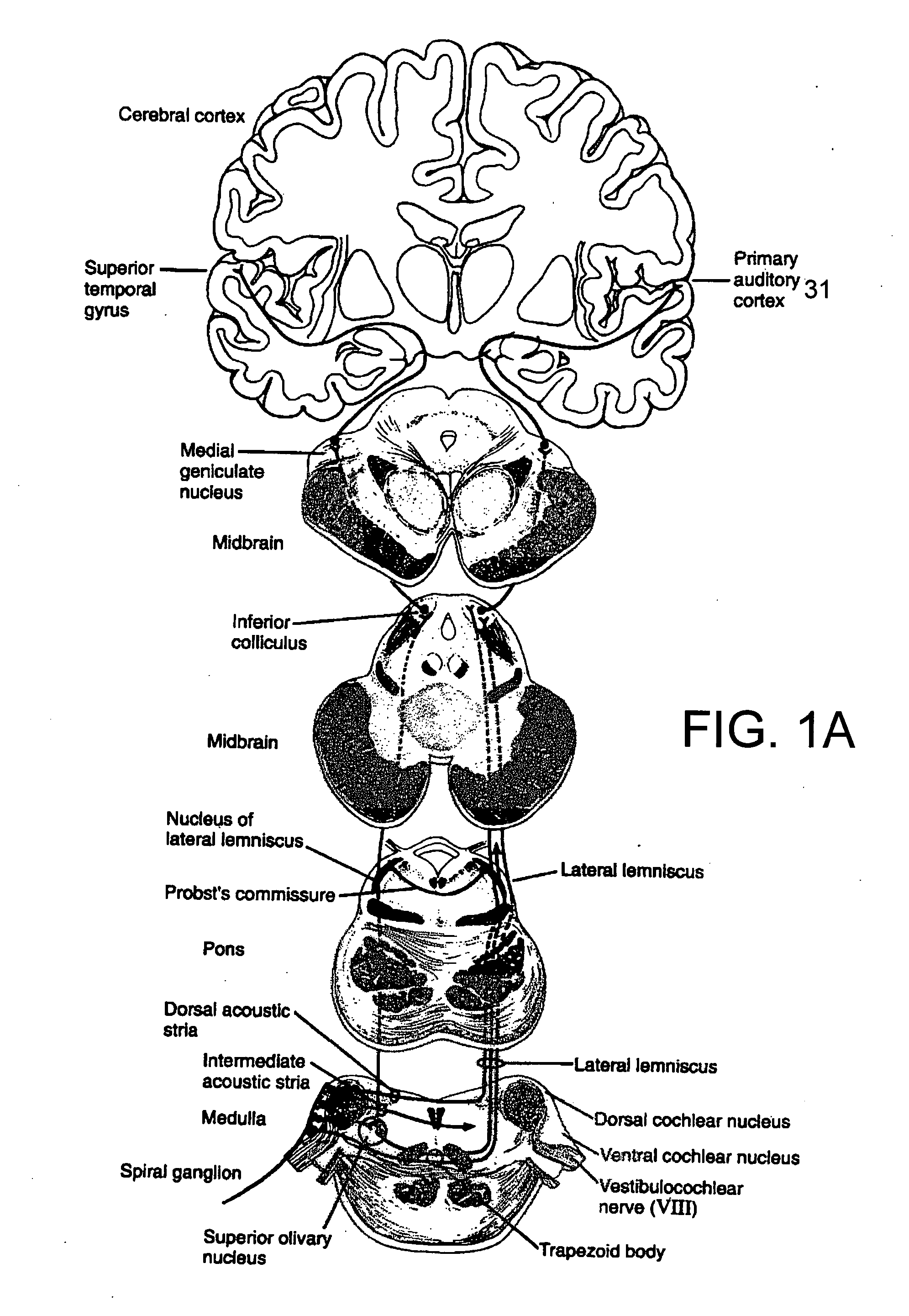 Method and system for cortical stimulation to provide adjunct (ADD-ON) therapy for stroke, tinnitus and other medical disorders using implantable and external components