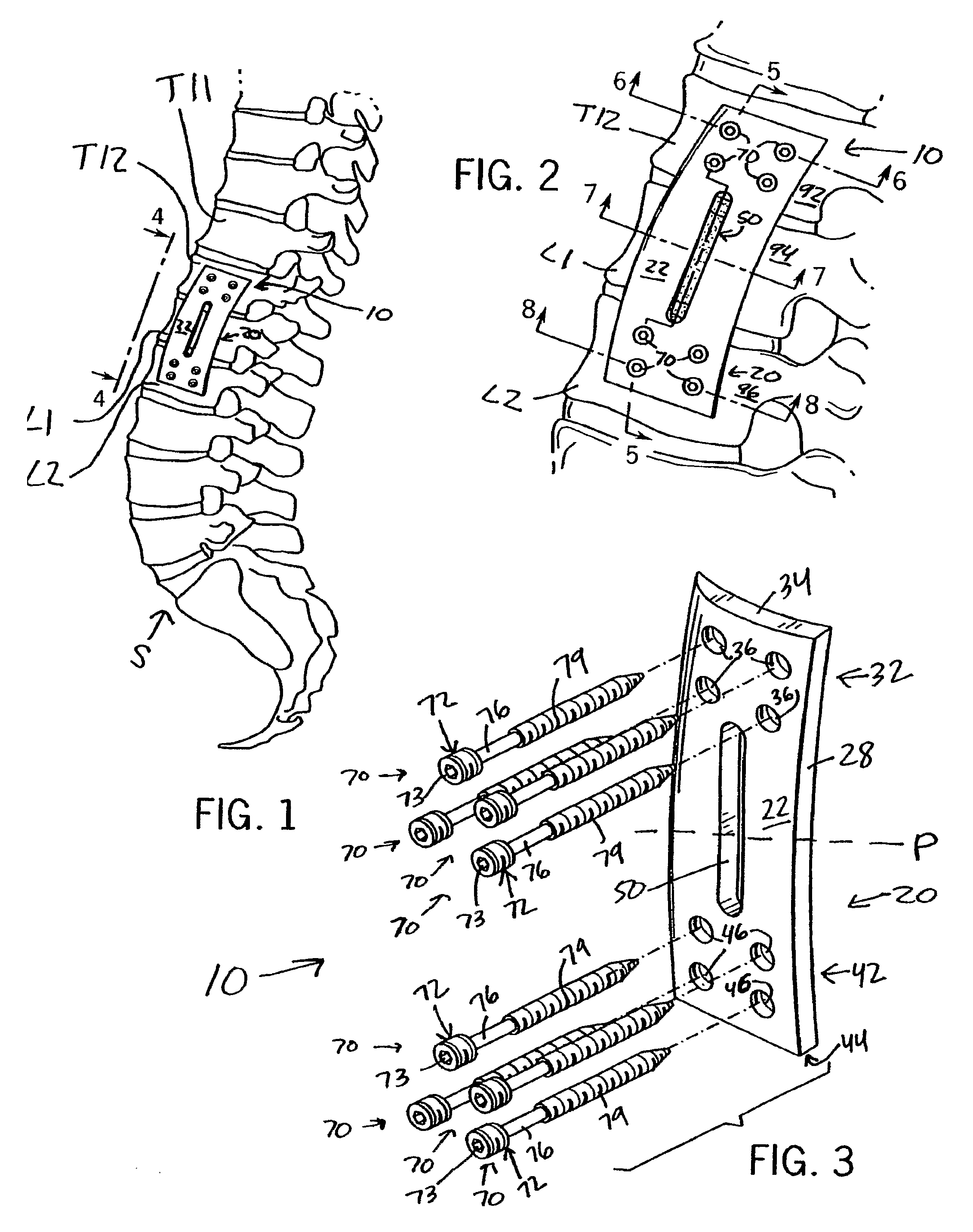 Anterior adherent thoracolumbar spine plate