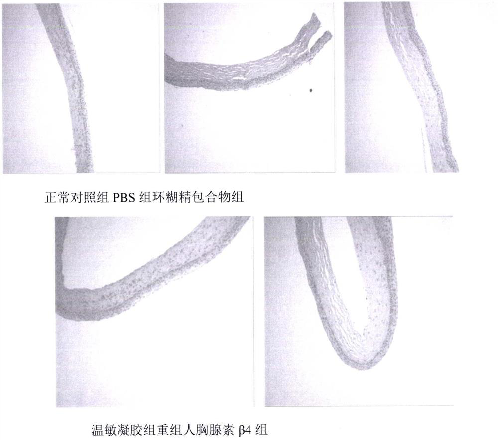 A temperature-sensitive recombinant human thymosin β4 ophthalmic in situ gel preparation