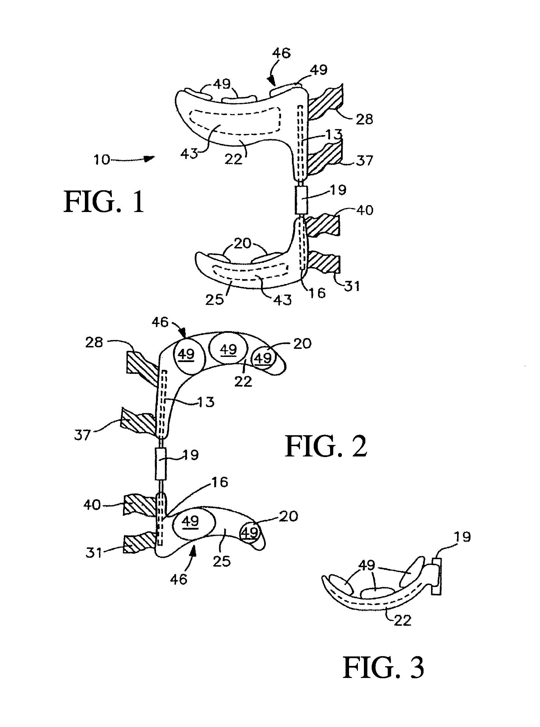 Bracing and electrostimulation for arthritis