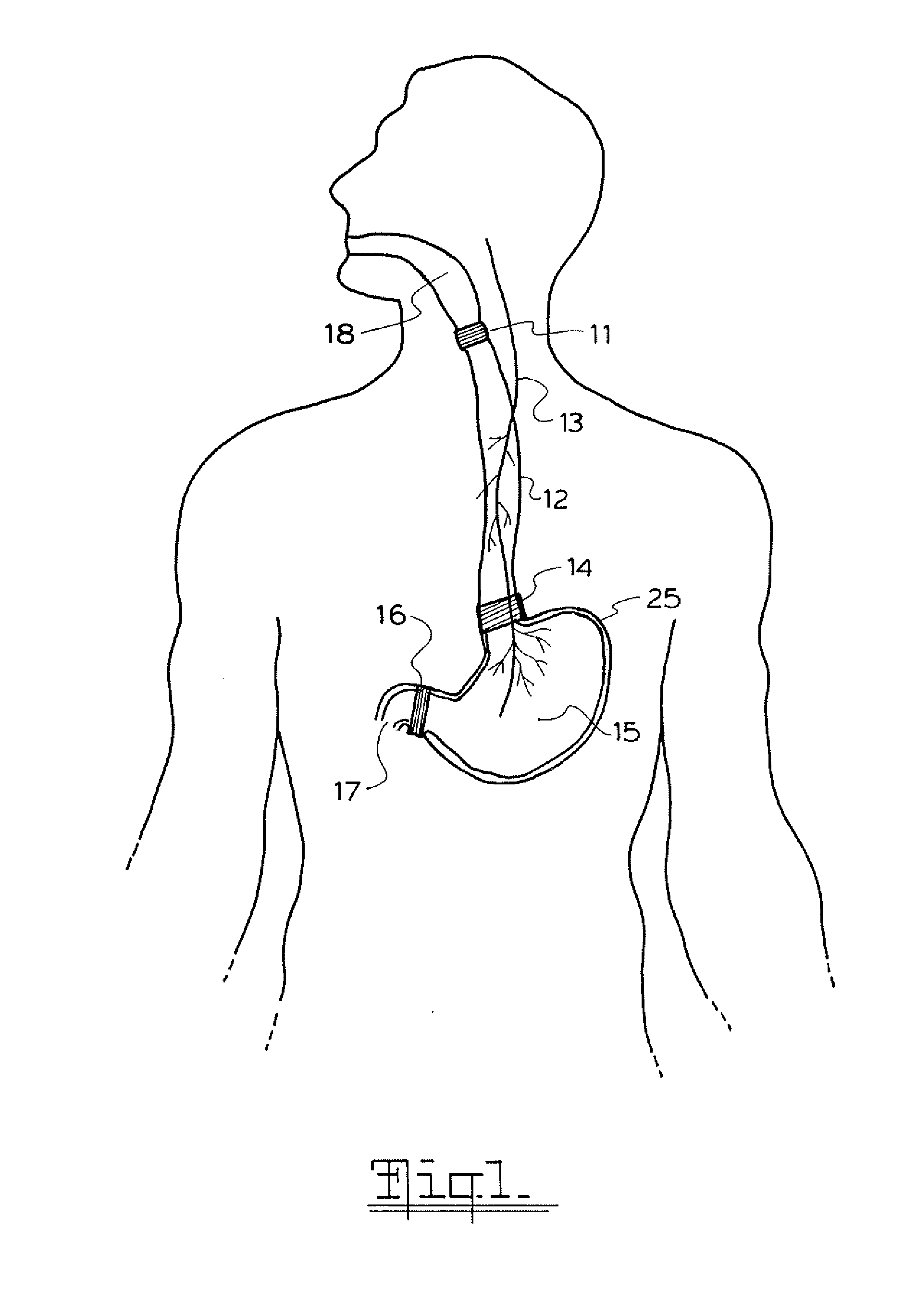 Method and apparatus for treatment of the gastrointestinal tract