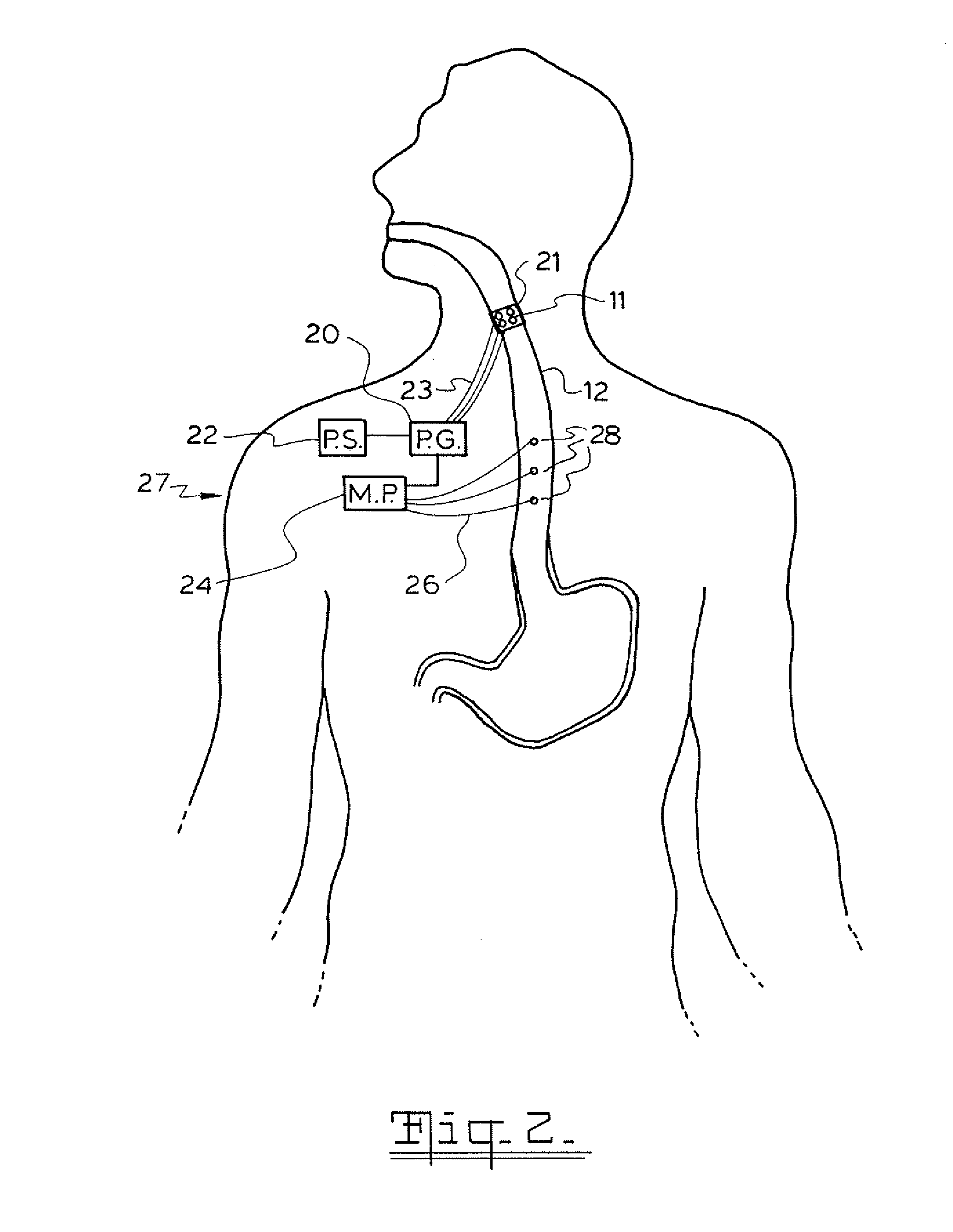 Method and apparatus for treatment of the gastrointestinal tract