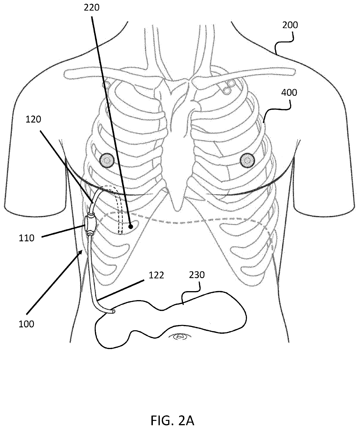 Automatic pleural-peritonal pump