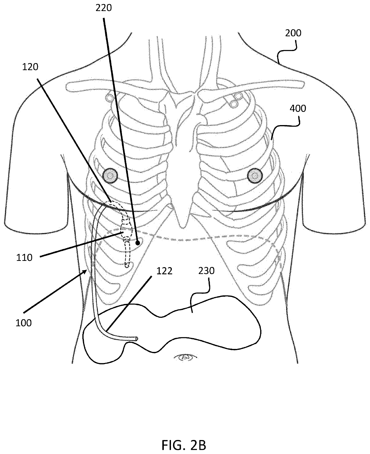 Automatic pleural-peritonal pump