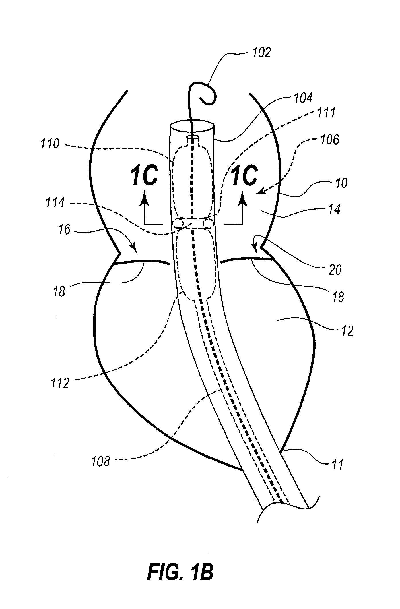 Percutaneous transcatheter repair of heart valves via trans-apical access