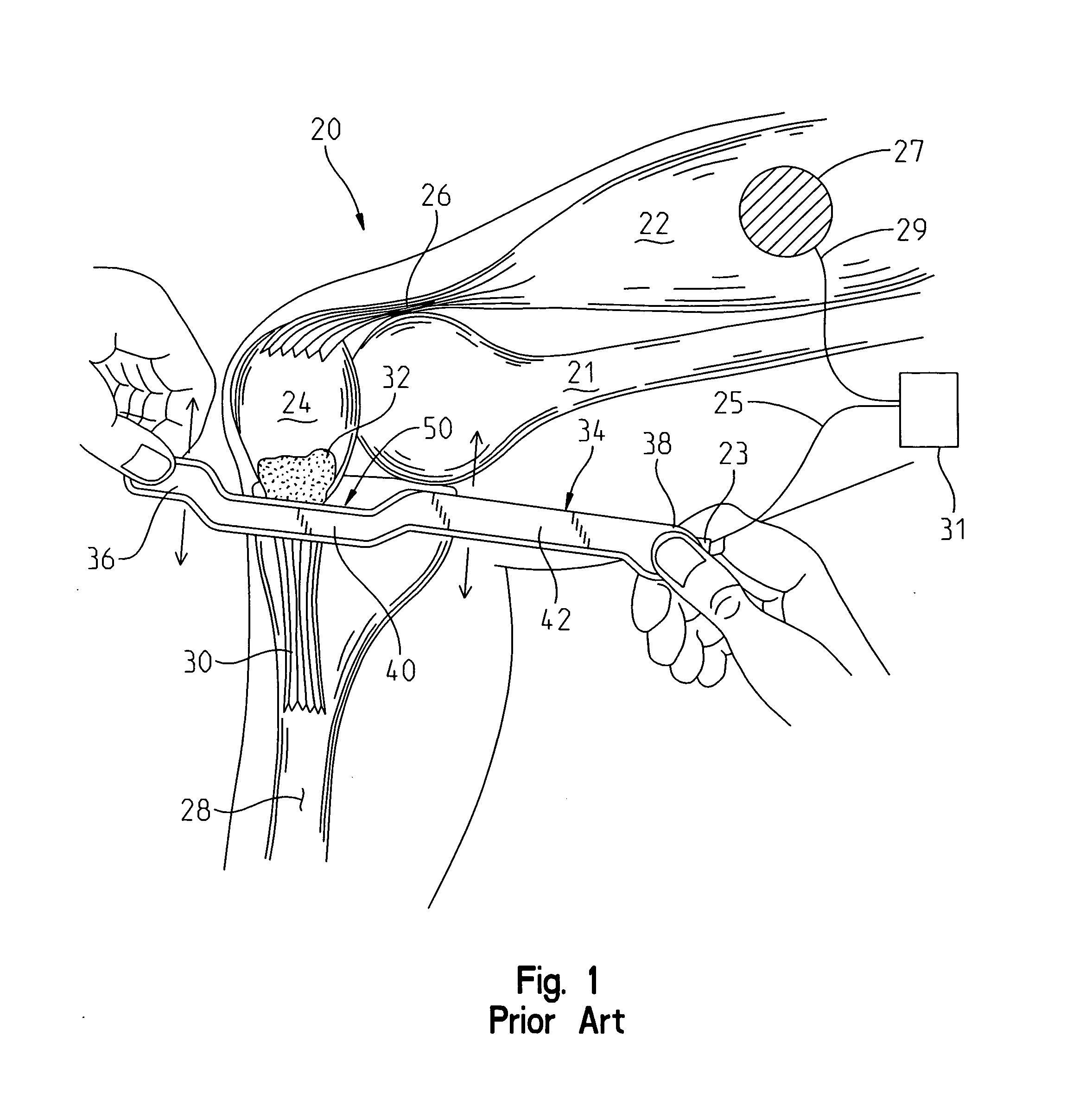 Soft tissue therapy device and method of use therefor