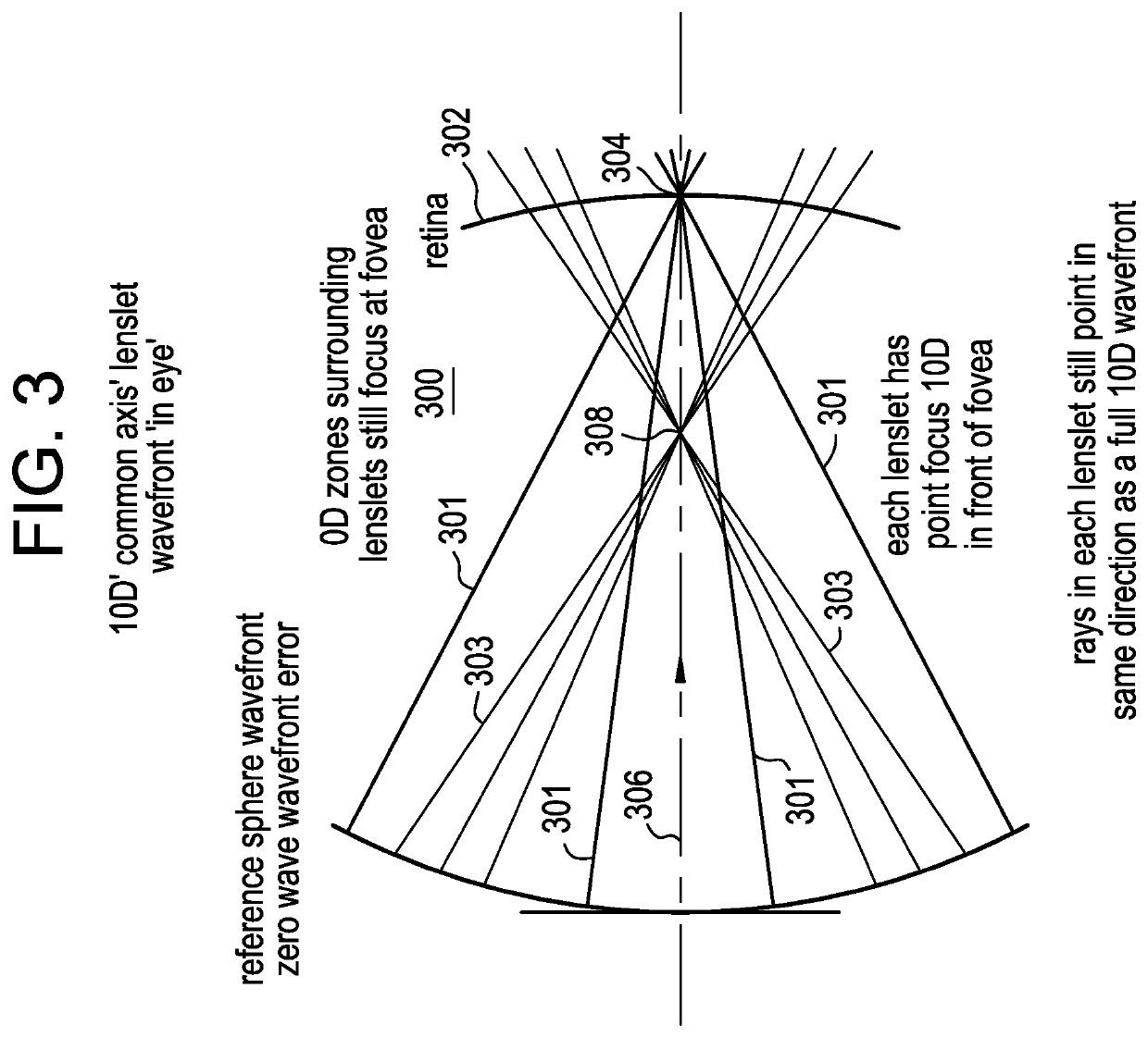 Contact lens comprising non-coaxial lenslets for preventing and/or slowing myopia progression