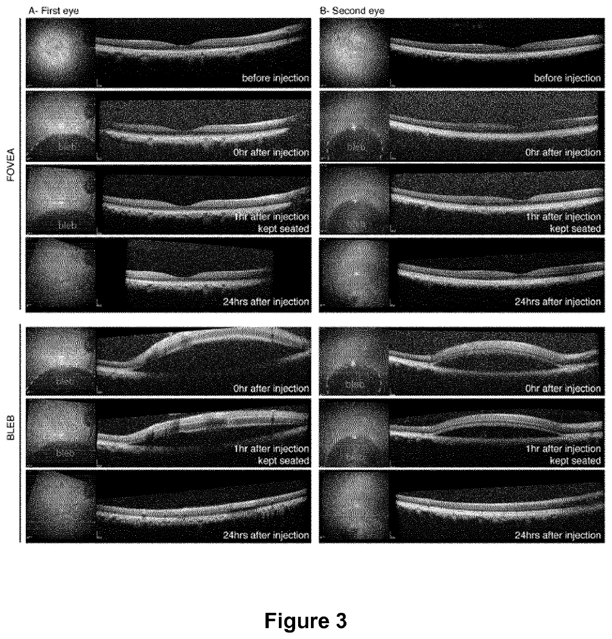 Methods of expressing a polynucleotide of interest in the cone photoreceptors of a subject comprising the subretinal delivery of a therapeutically effective amount of a recombinant aav9-derived vector