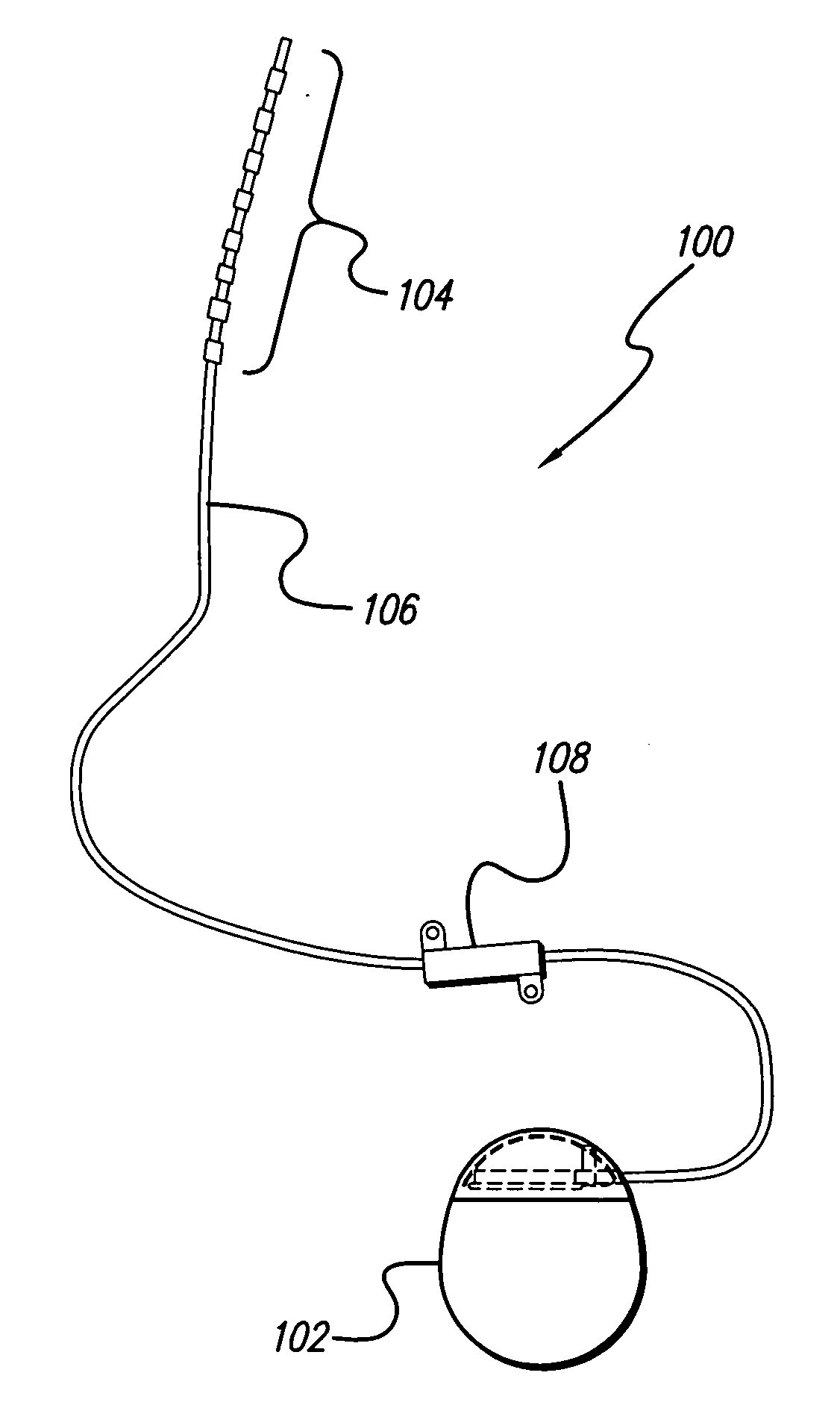 Lead anchor for implantable stimulation devices and methods of manufacture and use