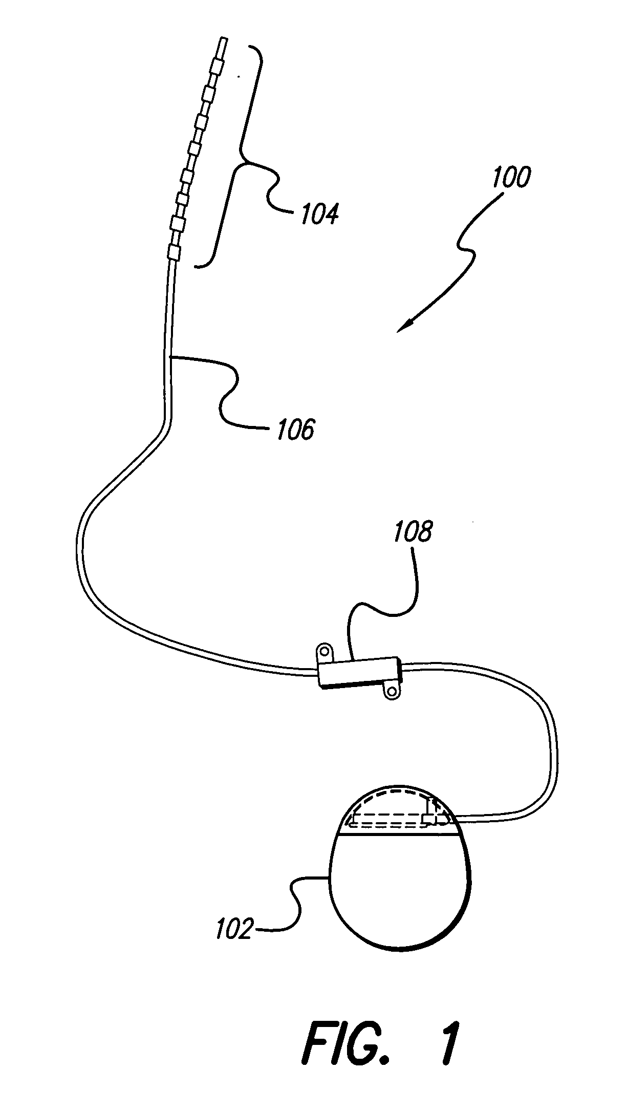 Lead anchor for implantable stimulation devices and methods of manufacture and use