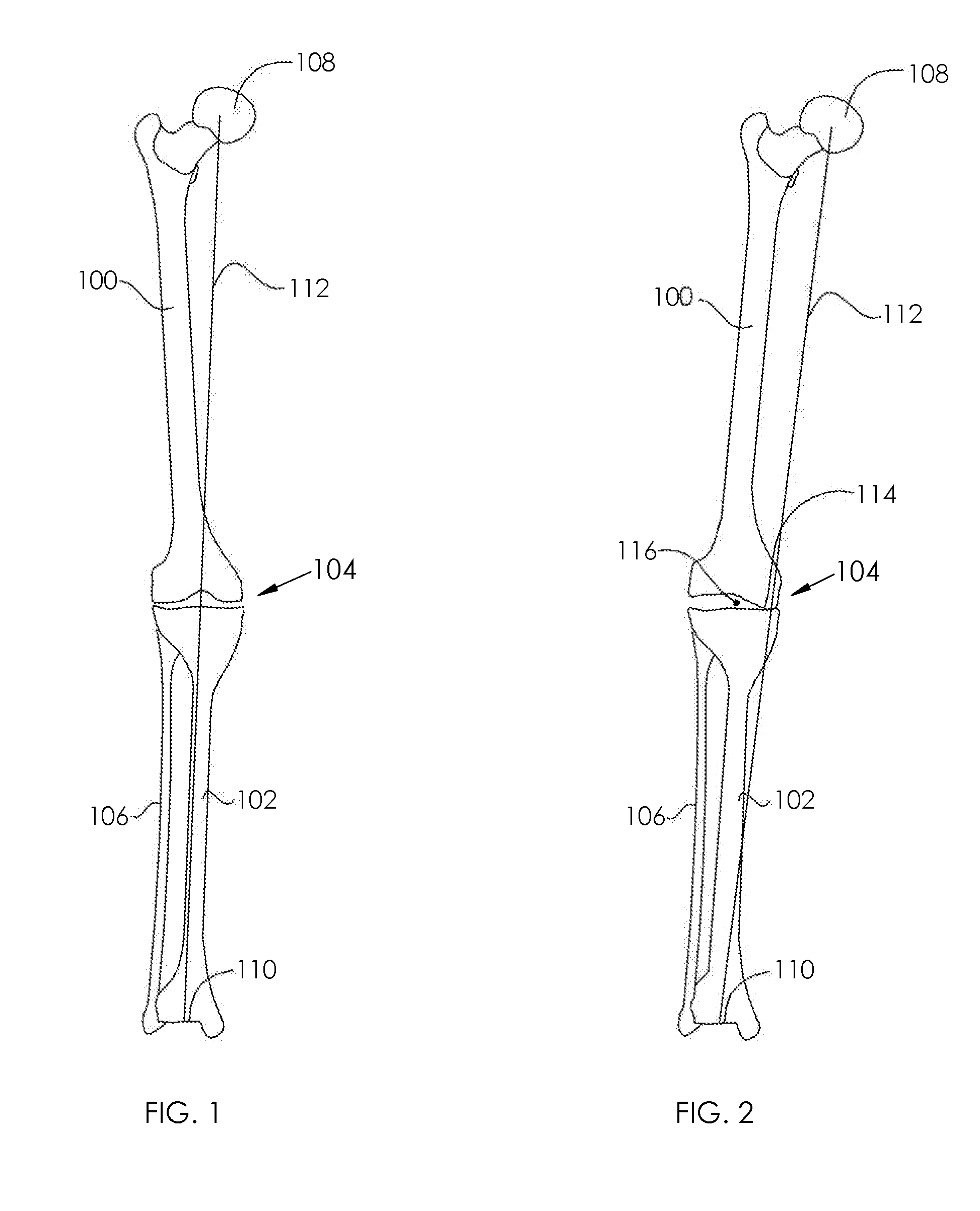 Adjustable devices for treating arthritis of the knee