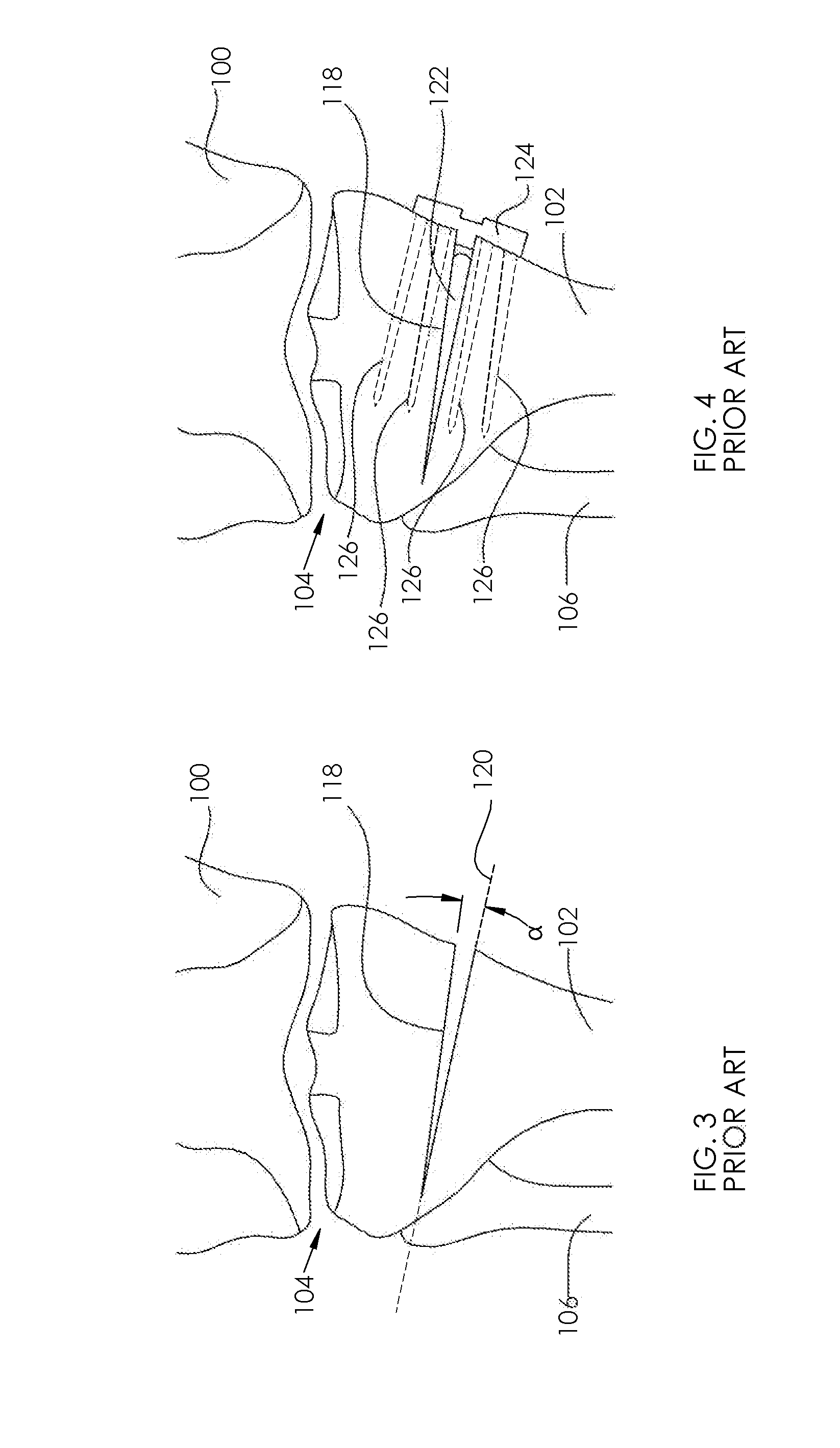 Adjustable devices for treating arthritis of the knee