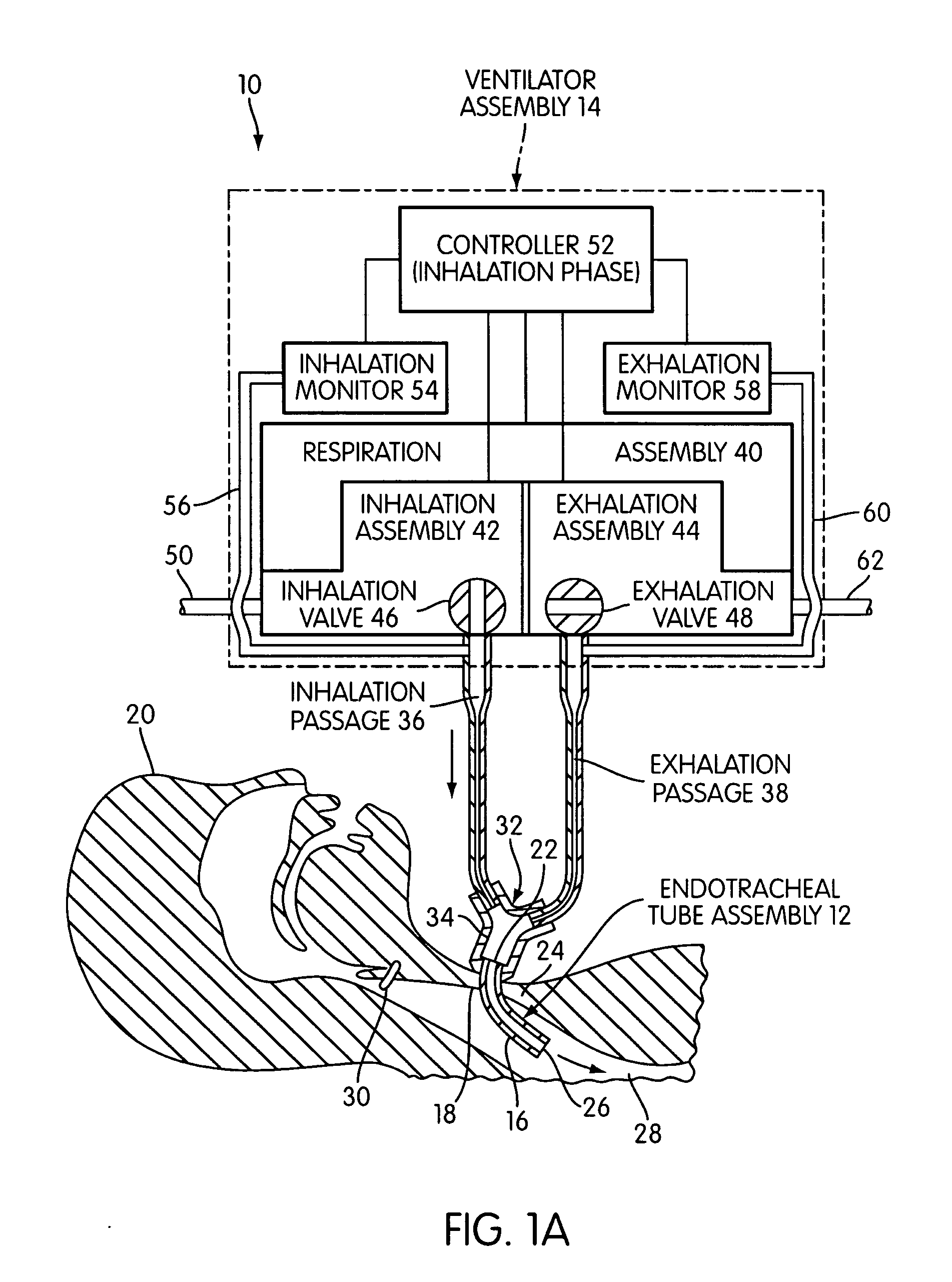 Ventilating apparatus and method enabling a patient to talk with or without a trachostomy tube check valve