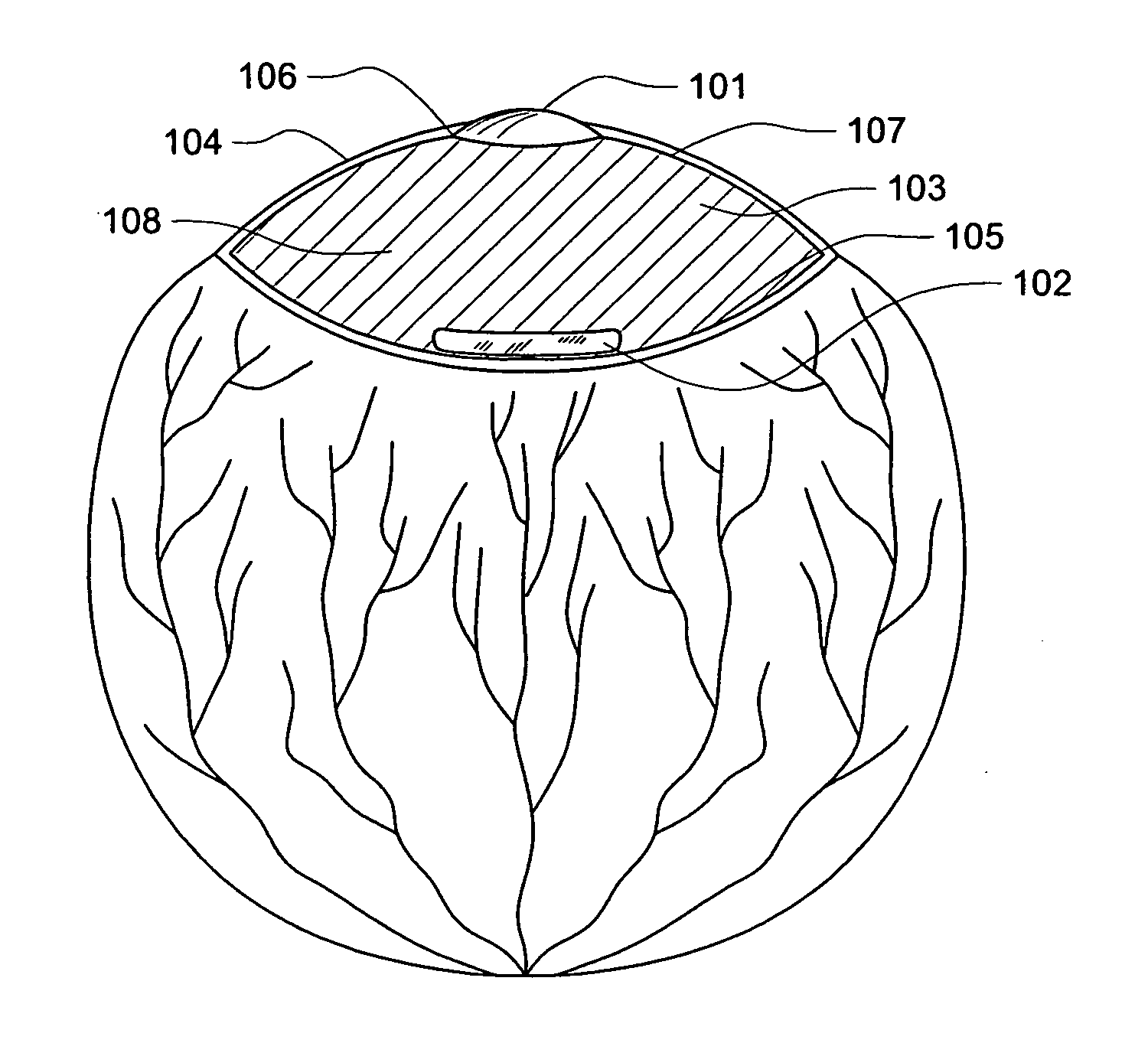 Multilens intraocular lens system with injectabe accommodation material