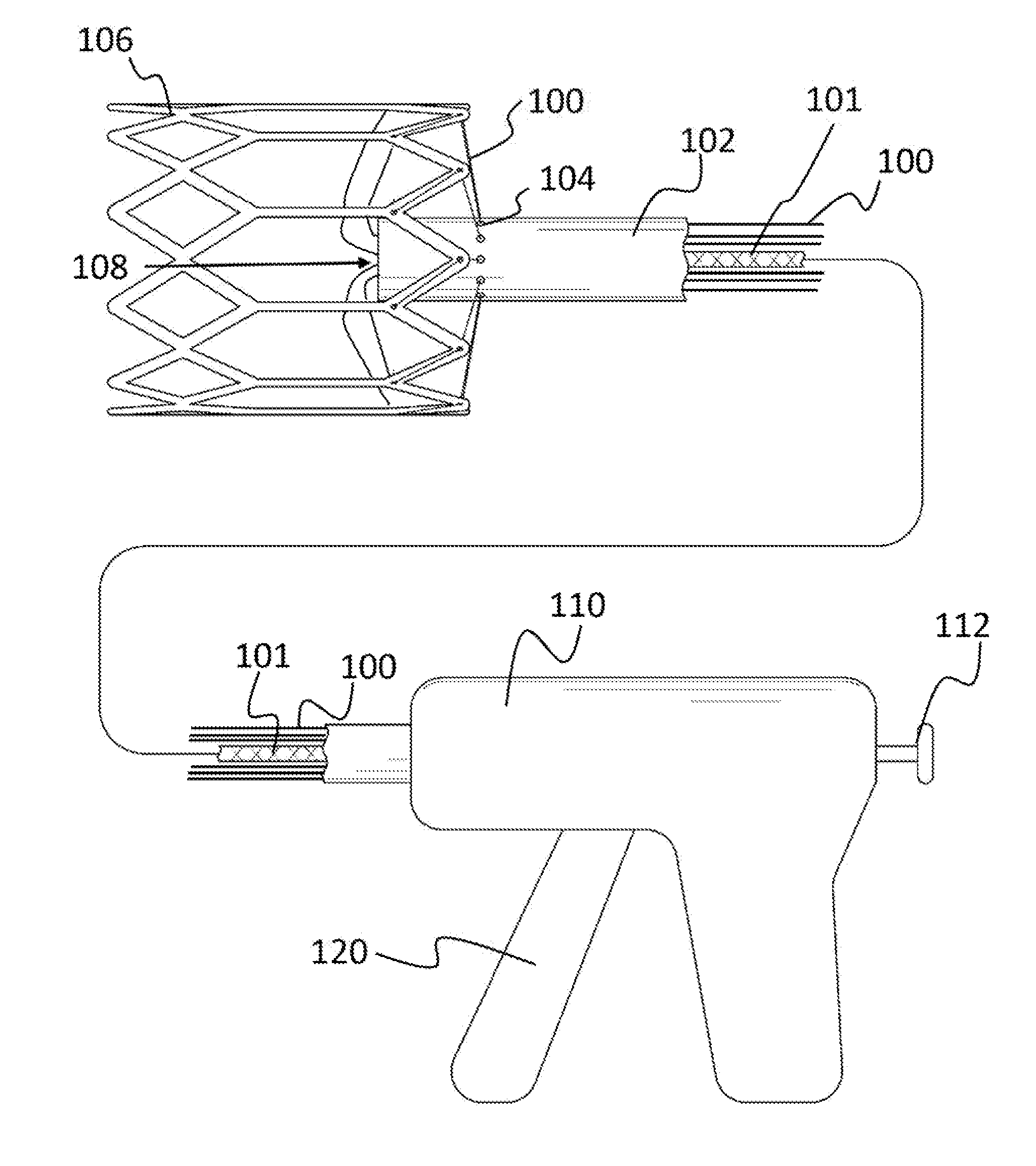 Delivery system for transcatheter detachment of a stent from the delivery device