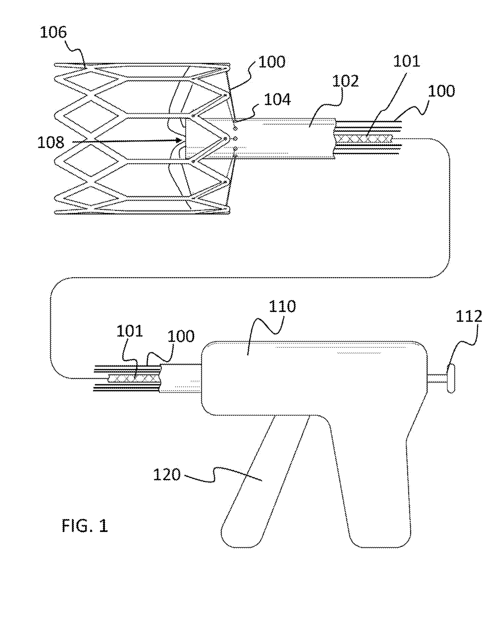 Delivery system for transcatheter detachment of a stent from the delivery device