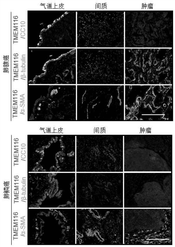 Molecular markers related to proliferation and metastasis of lung cancer and their application