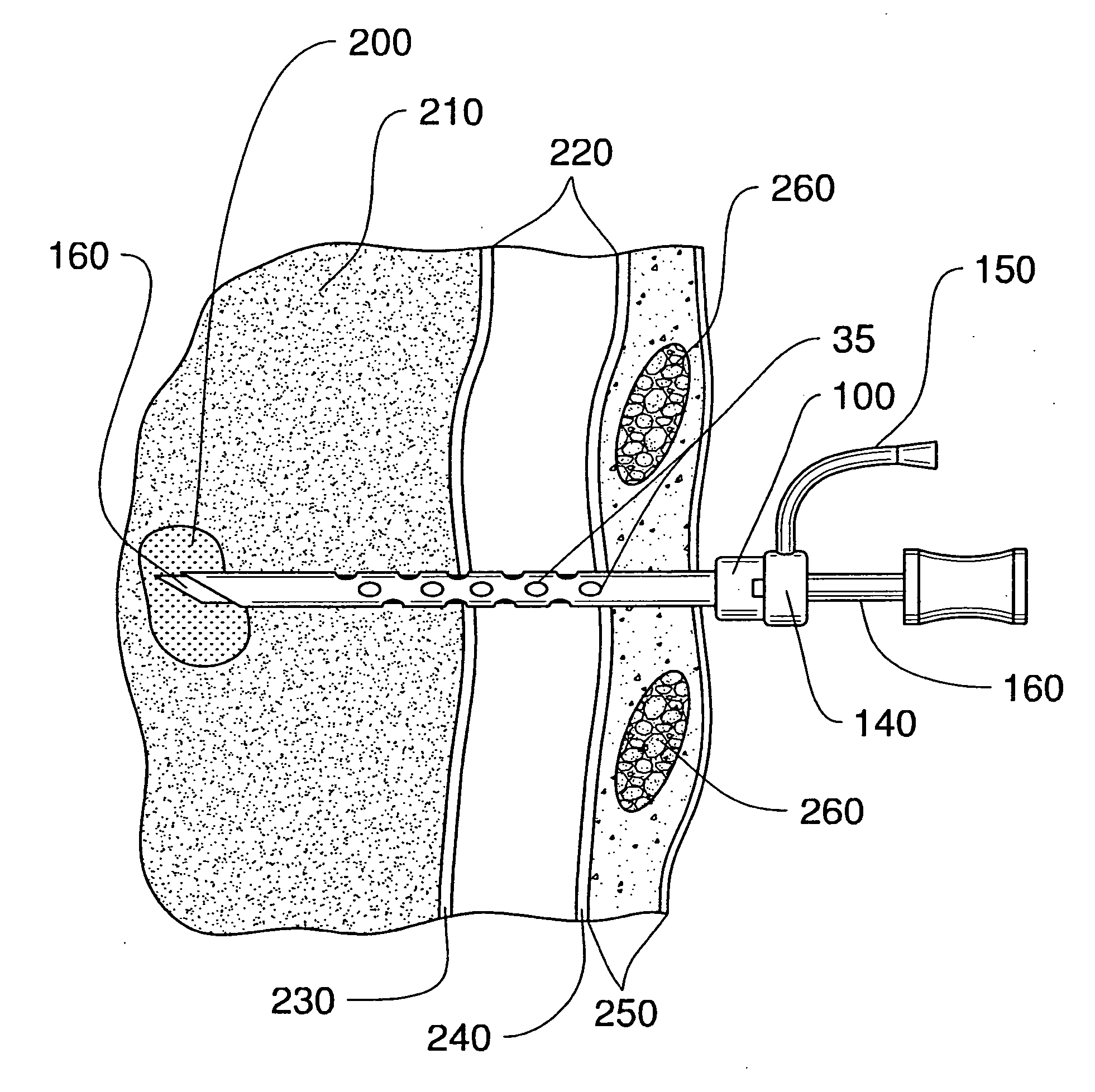 Medical devices and related methods