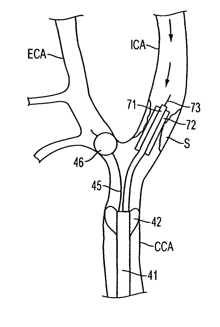 Apparatus and methods for reducing embolization during treatment of carotid artery disease