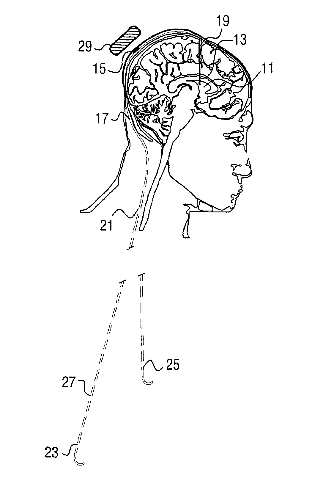 Electroactive polymer actuated cerebrospinal fluid shunt