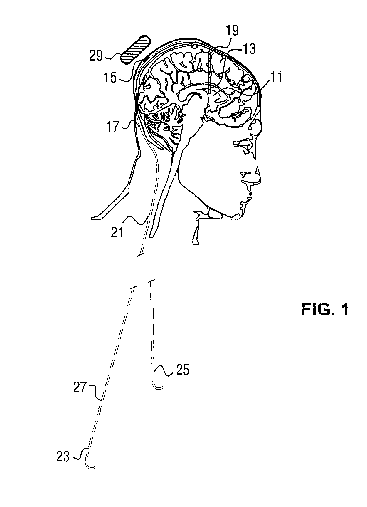 Electroactive polymer actuated cerebrospinal fluid shunt