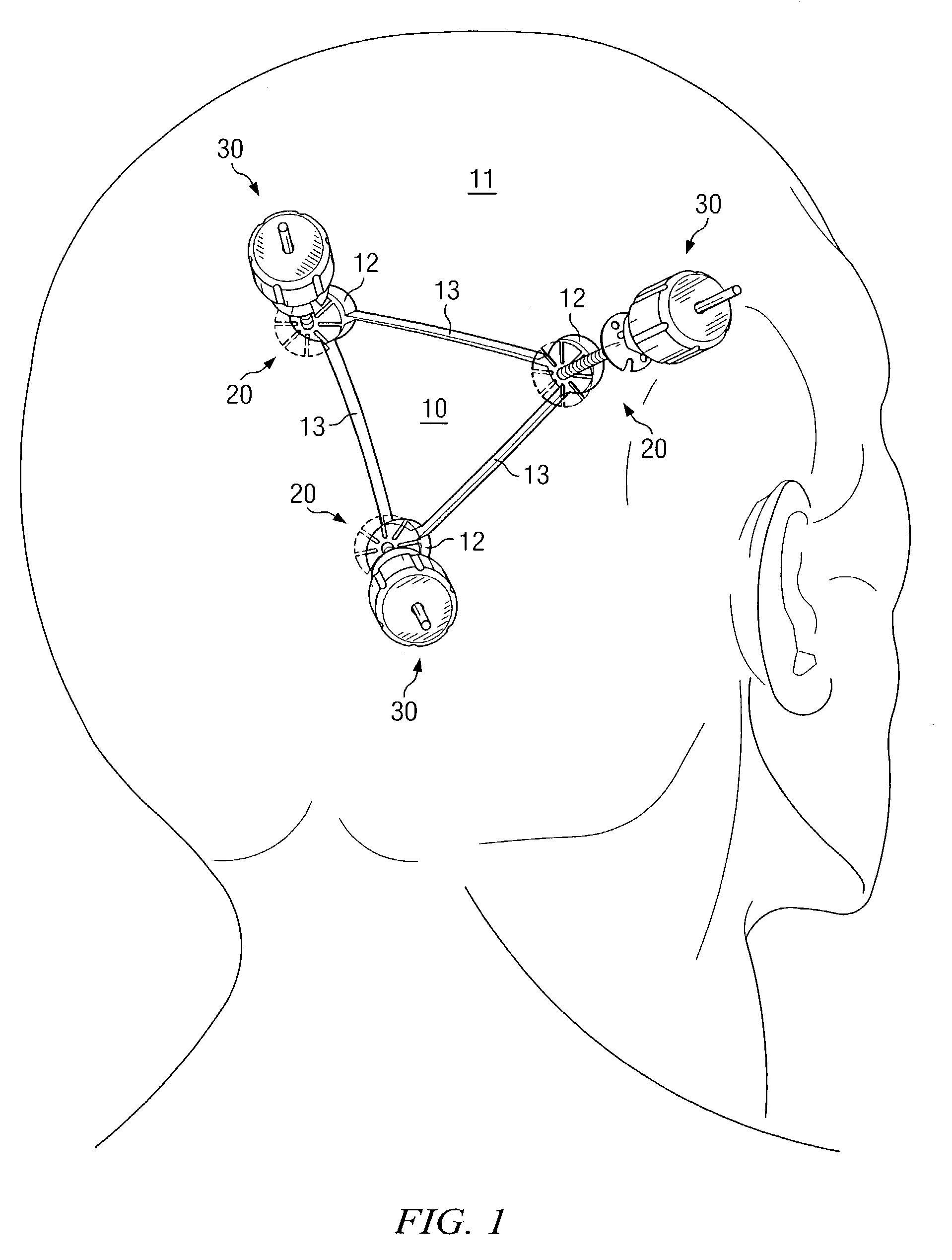 Cranial flap fixation system and method