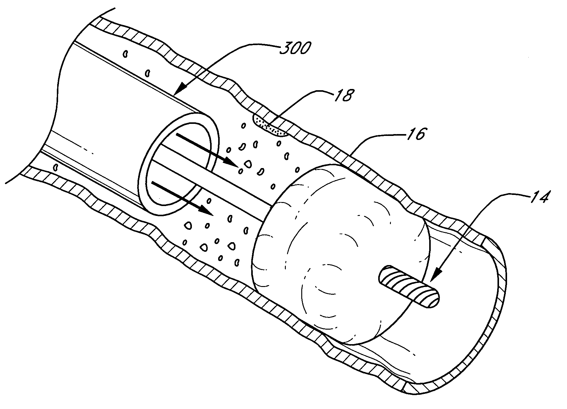 Methods and apparatuses for drug delivery to an intravascular occlusion