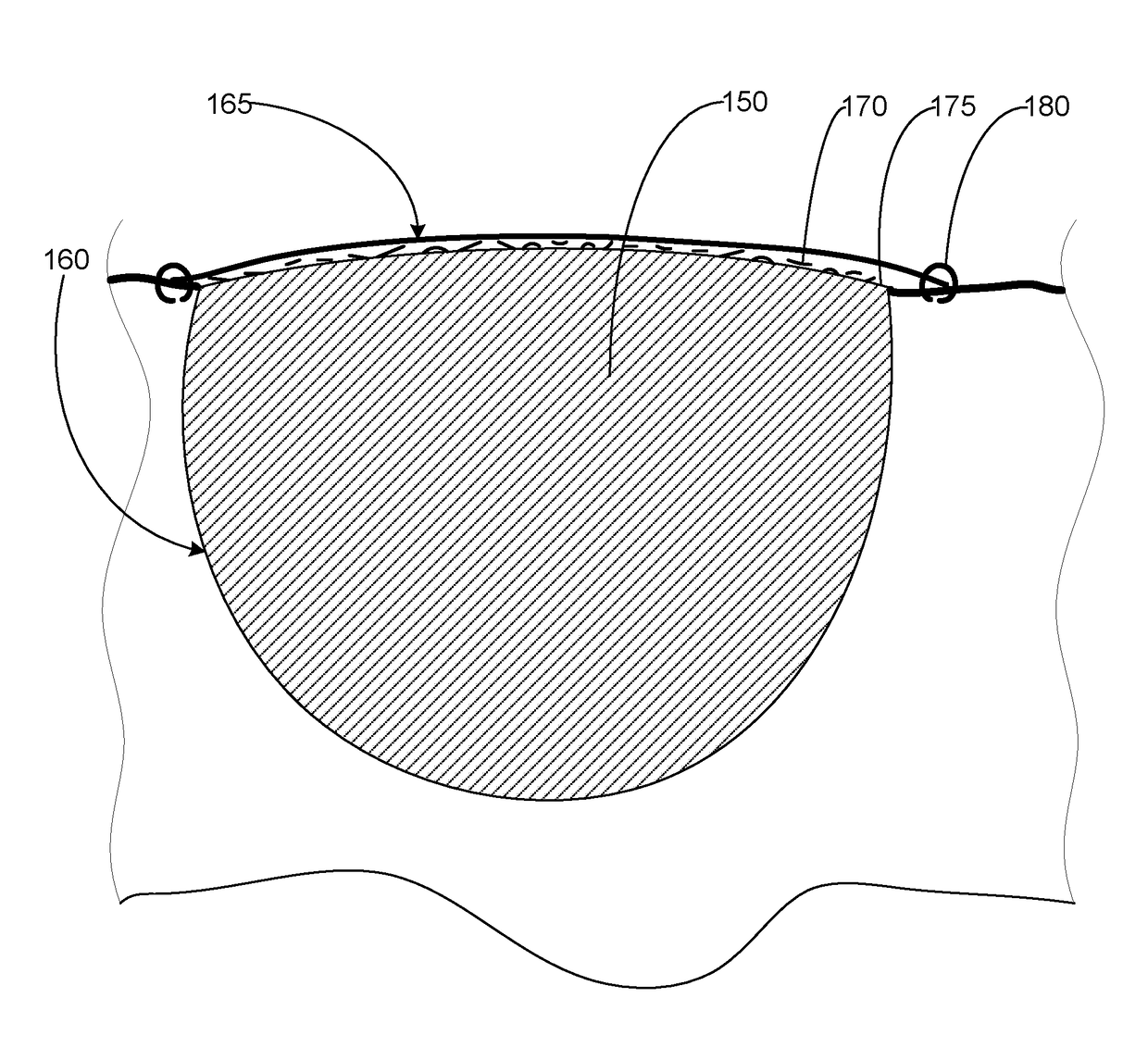 Systems and methods for treating a wound with wound packing