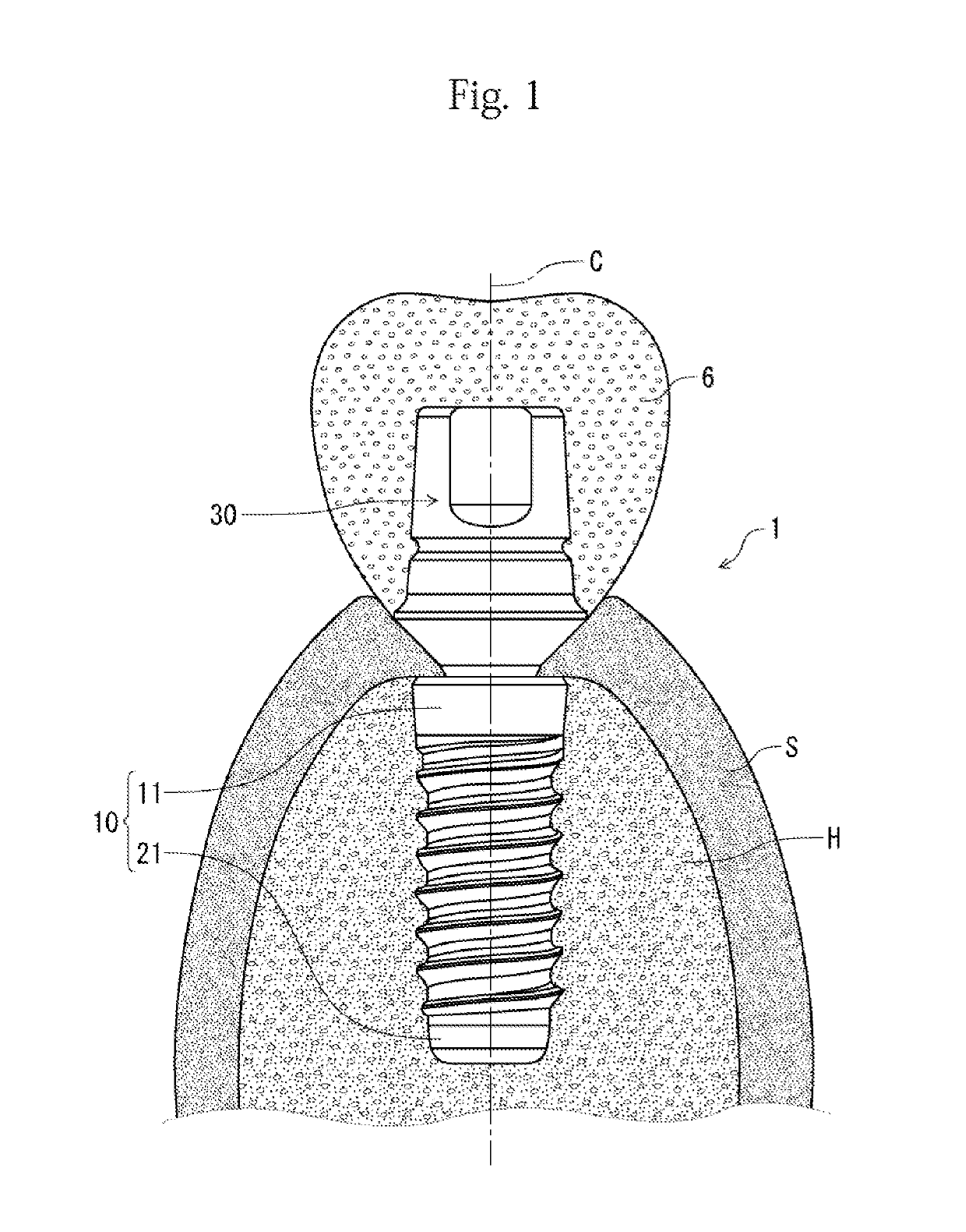 Fixture and implant