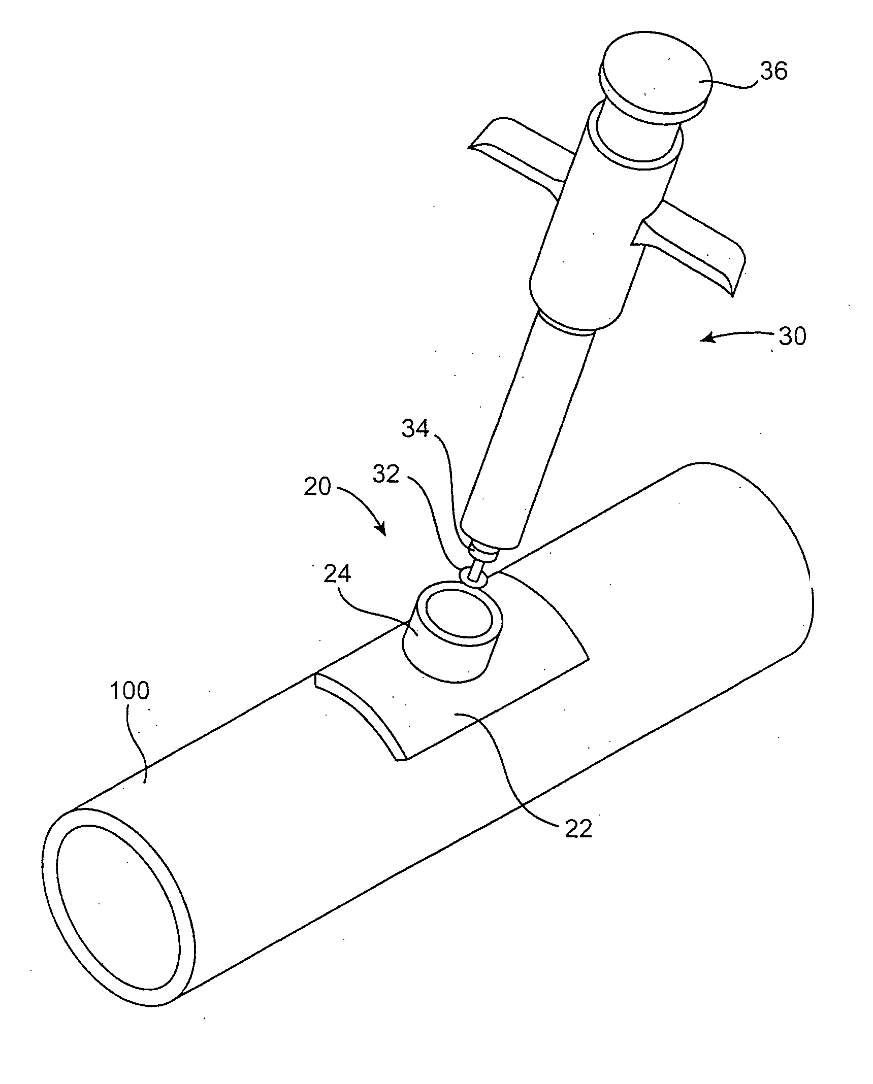 Anastomosis system utilizing an access port