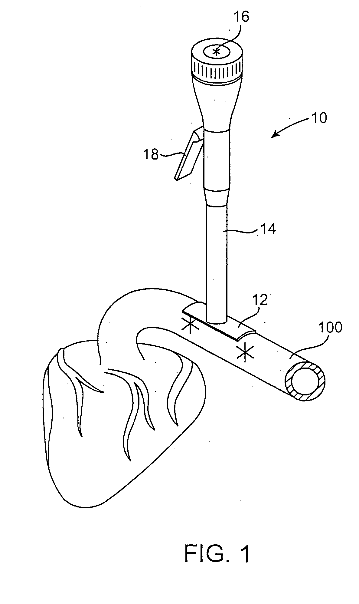 Anastomosis system utilizing an access port