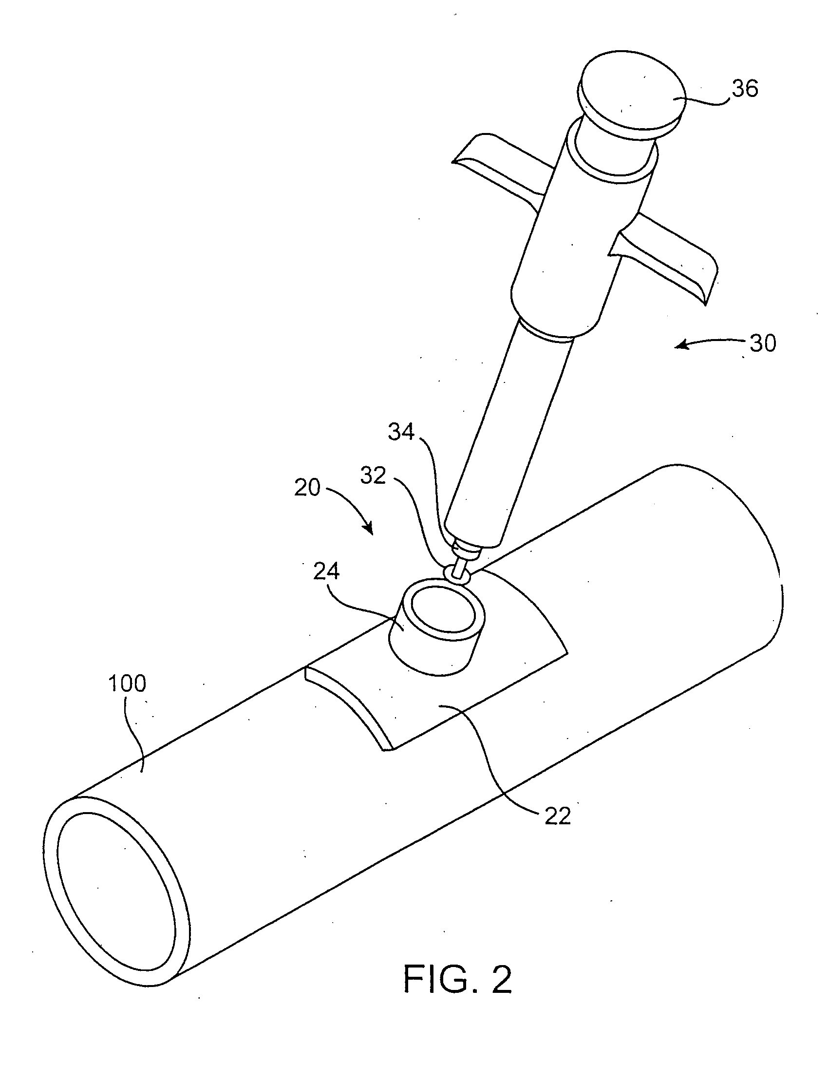 Anastomosis system utilizing an access port