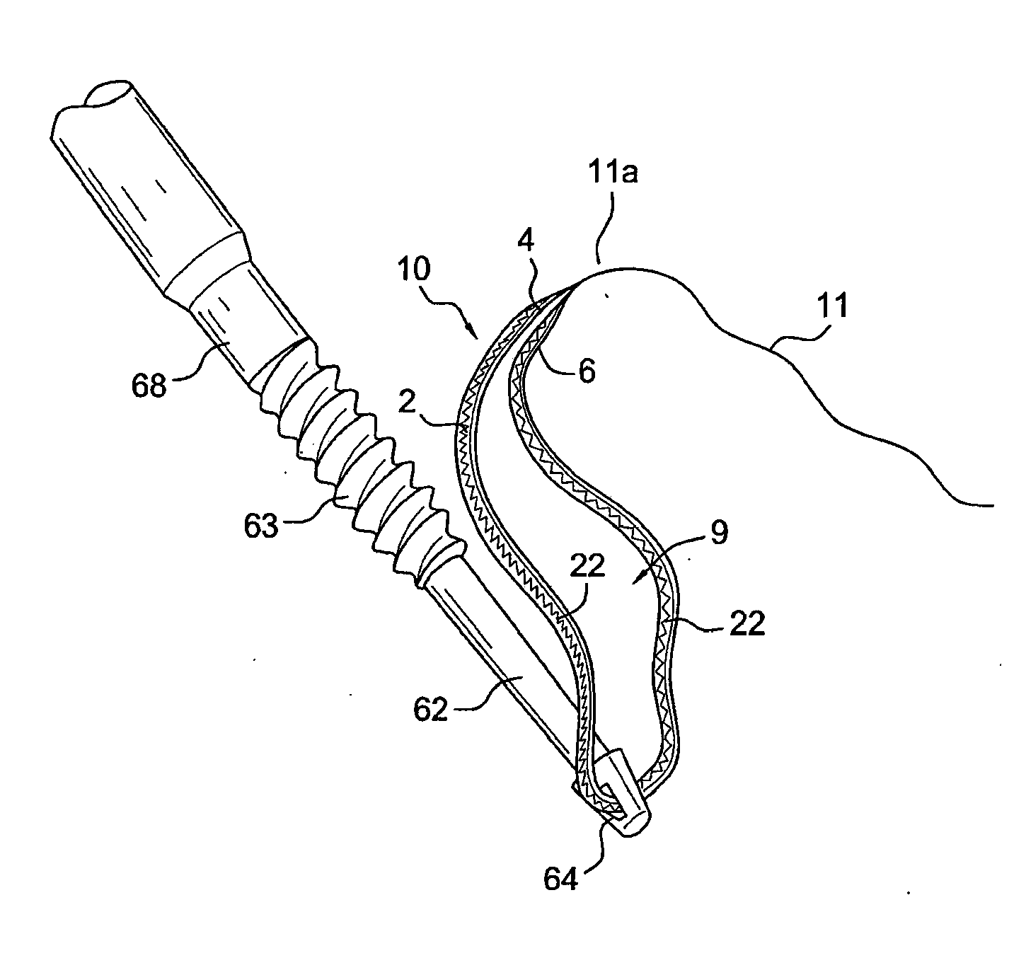 Suturing construct with spliced tails