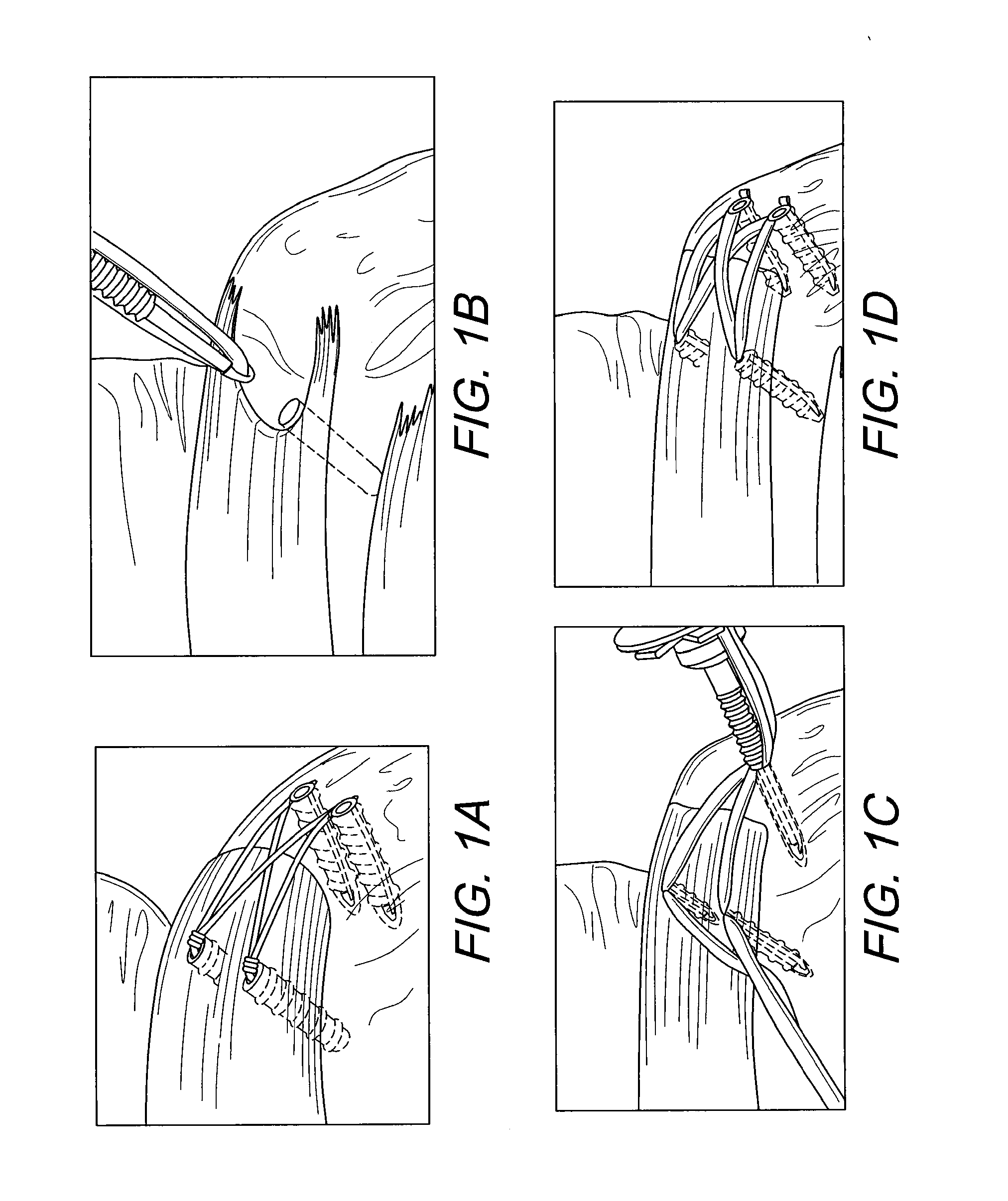 Suturing construct with spliced tails