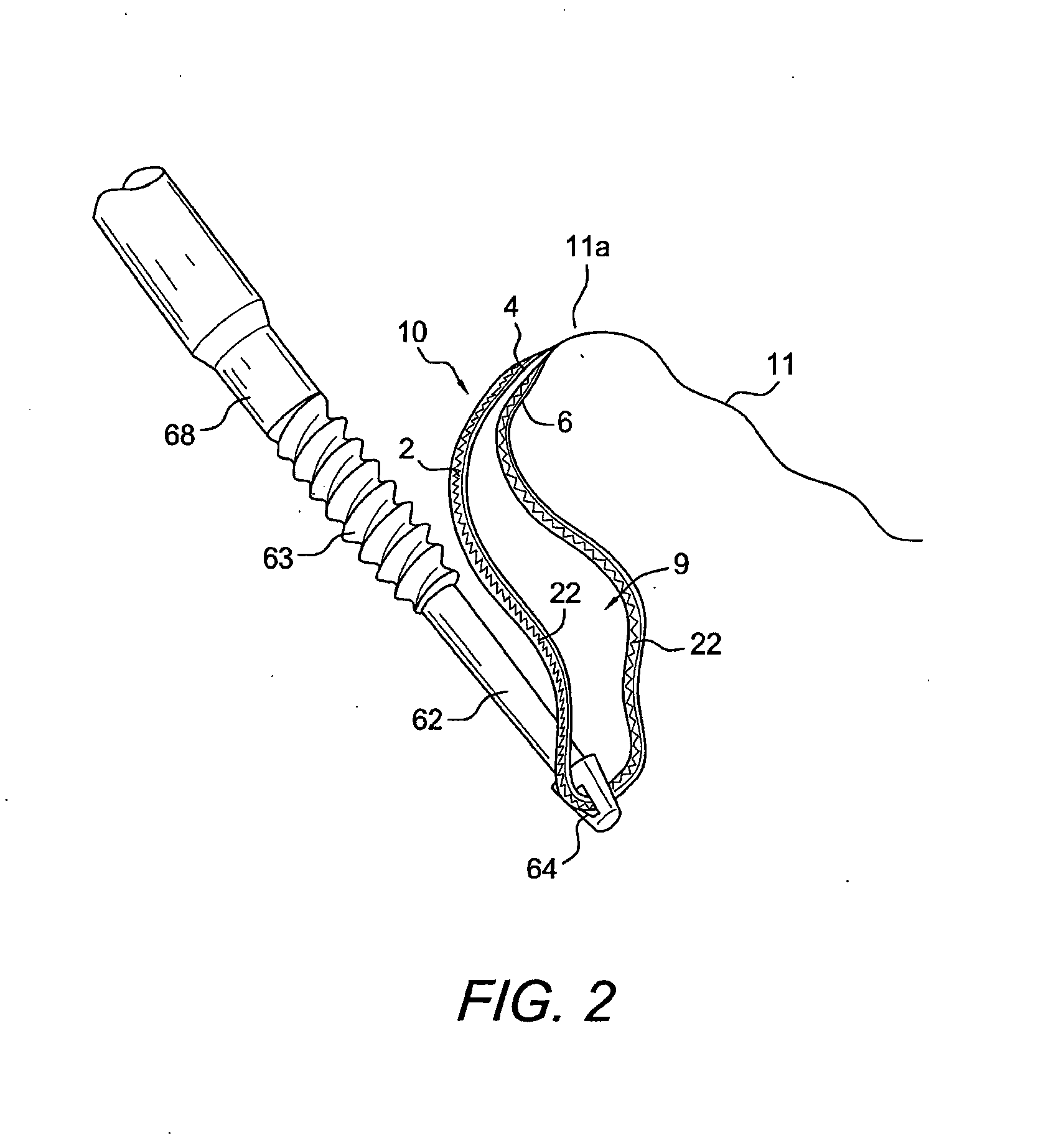 Suturing construct with spliced tails