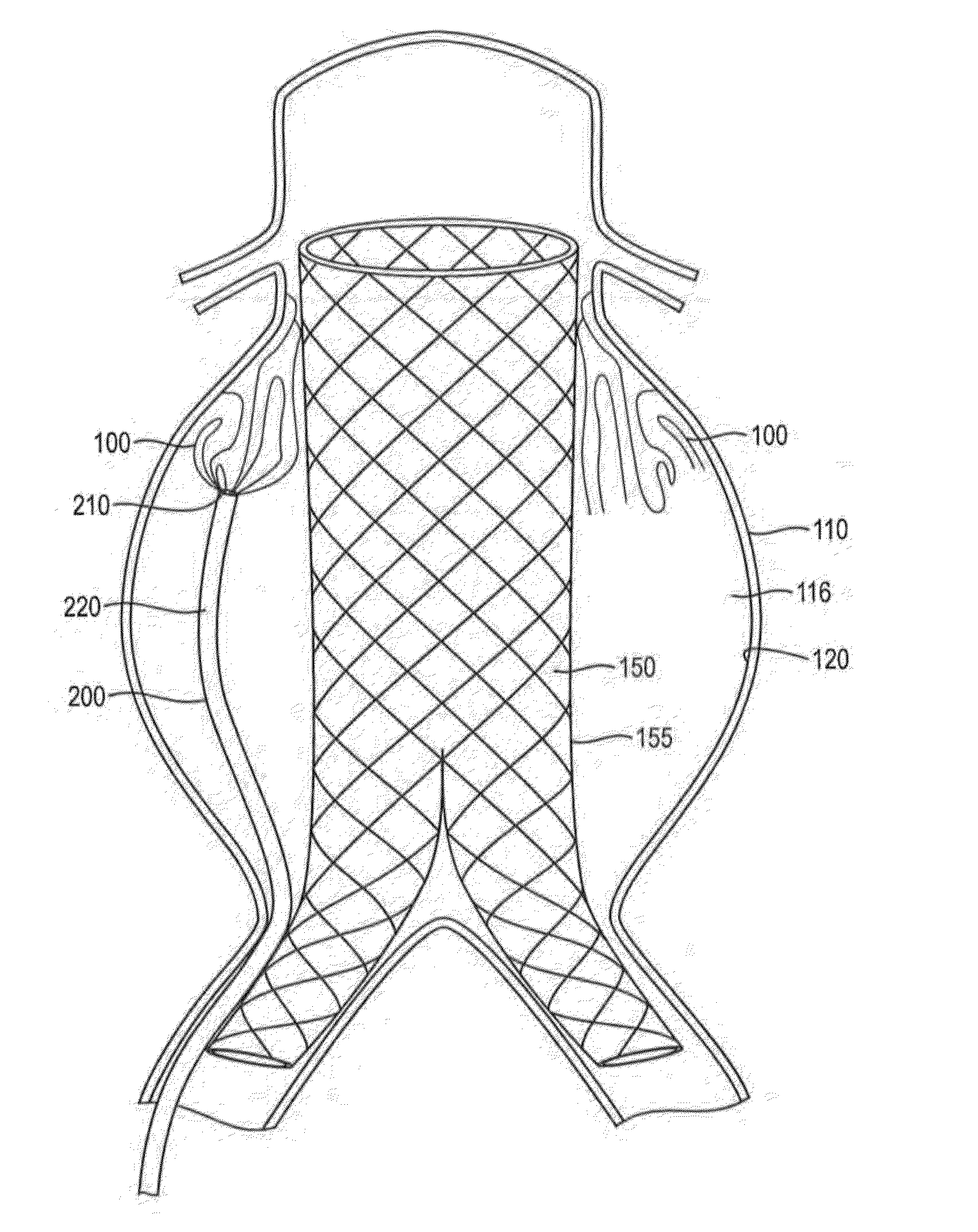 In-situ Forming foams with outer layer