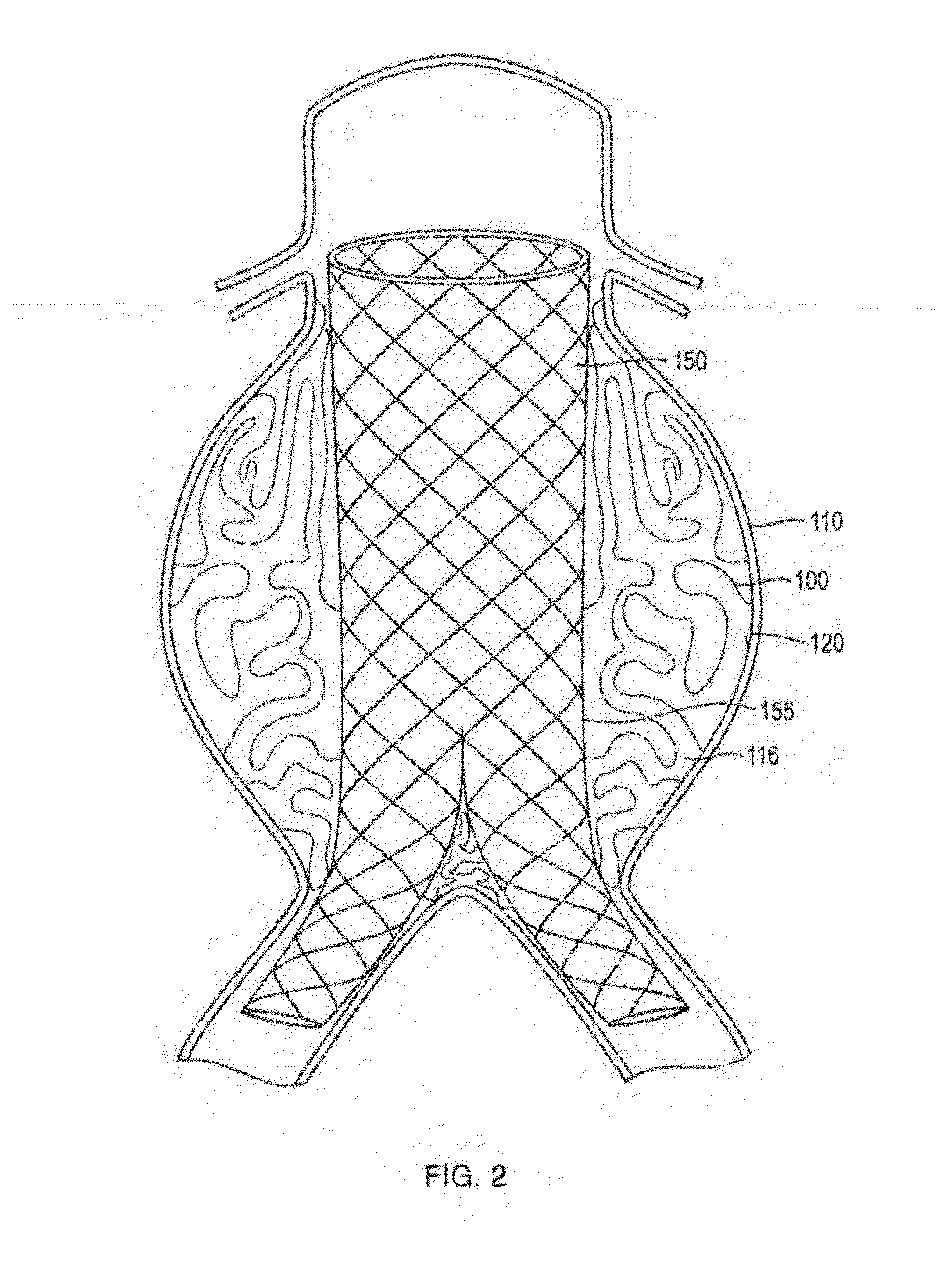 In-situ Forming foams with outer layer