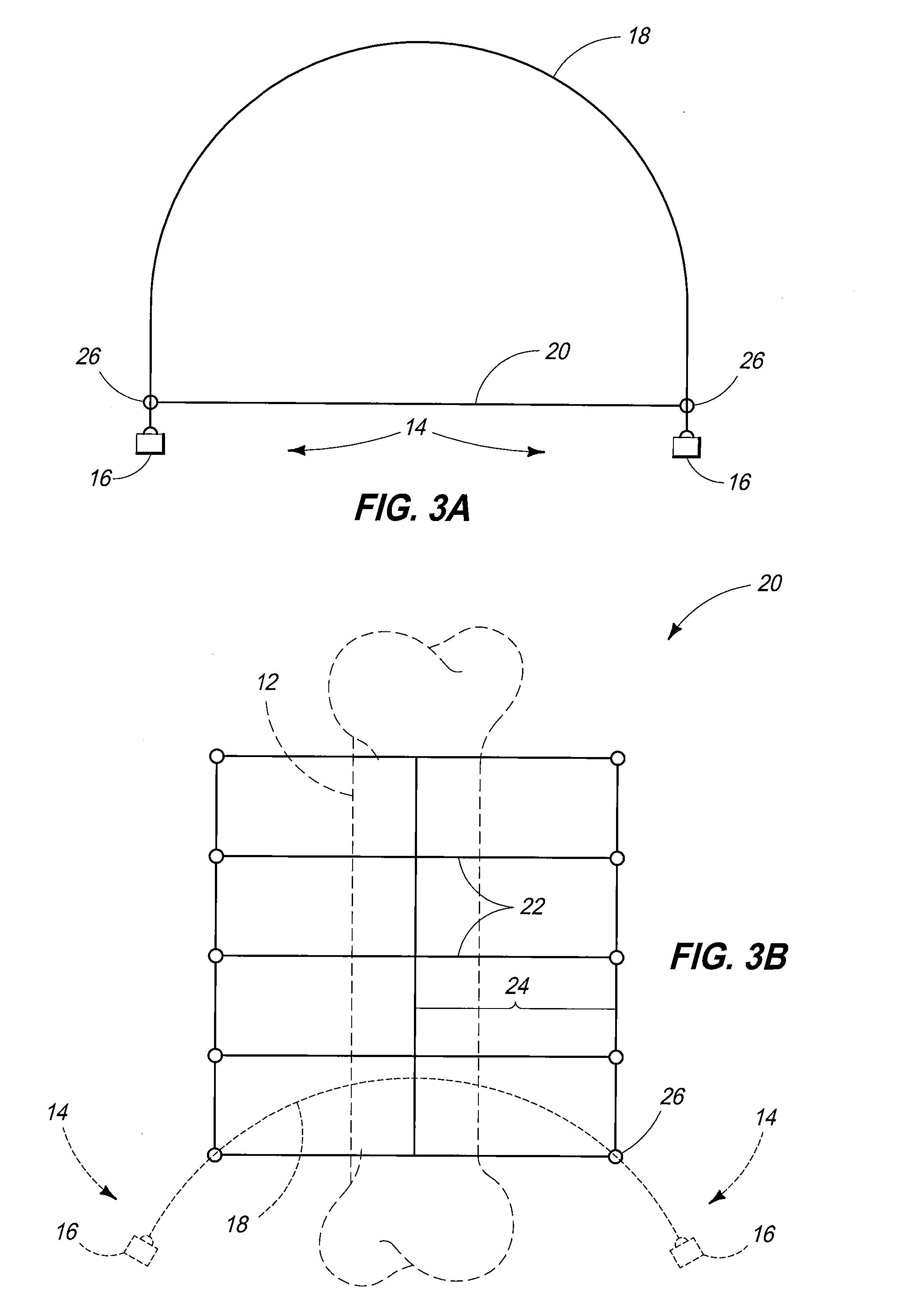 Fractured Bone Treatment Methods And Fractured Bone Treatment Assemblies