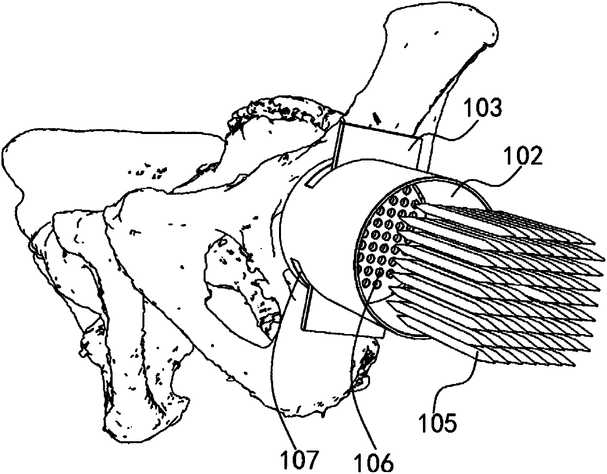 Acetabular prosthesis positioning apparatus