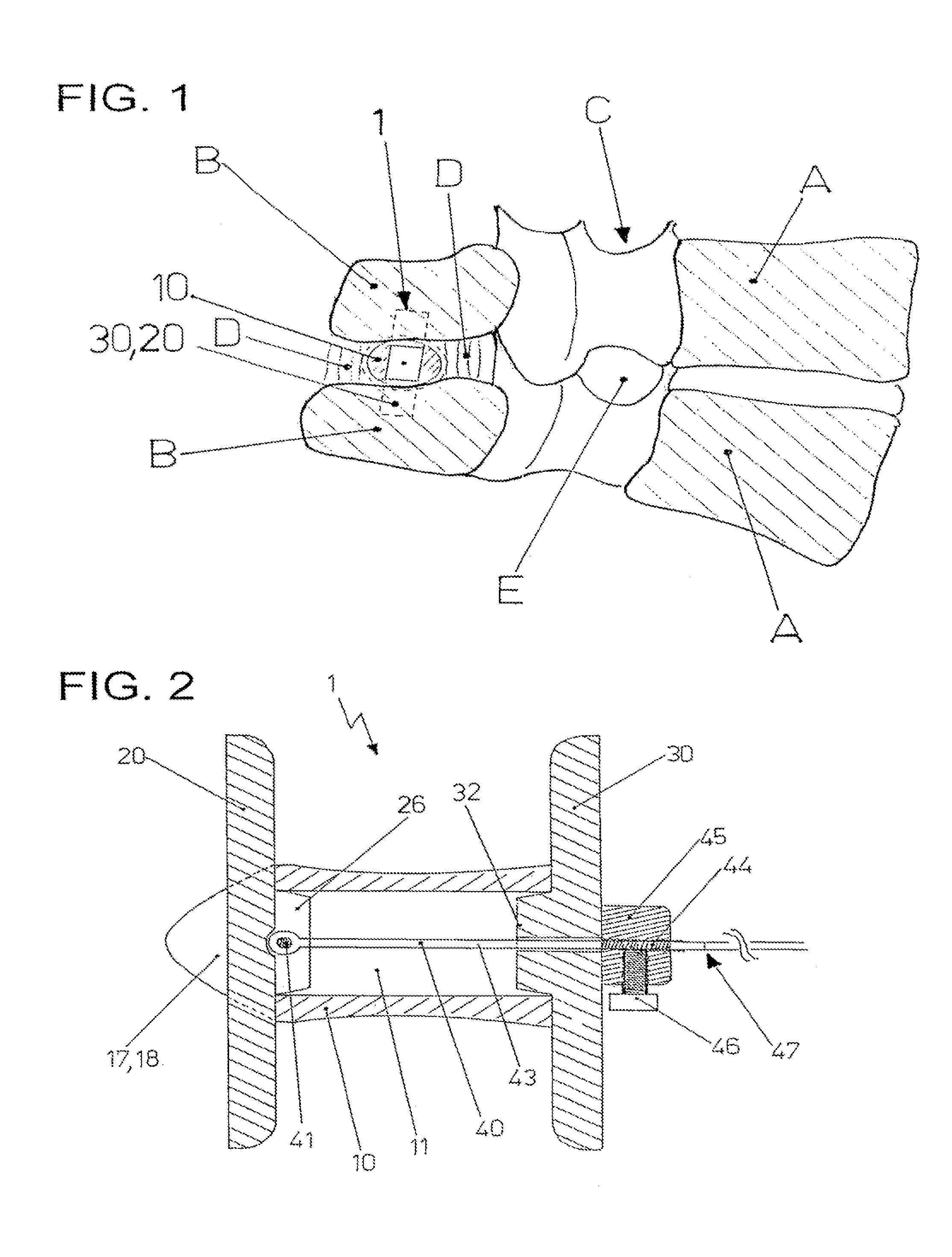 Implant for the treatment of lumbar spinal canal stenosis