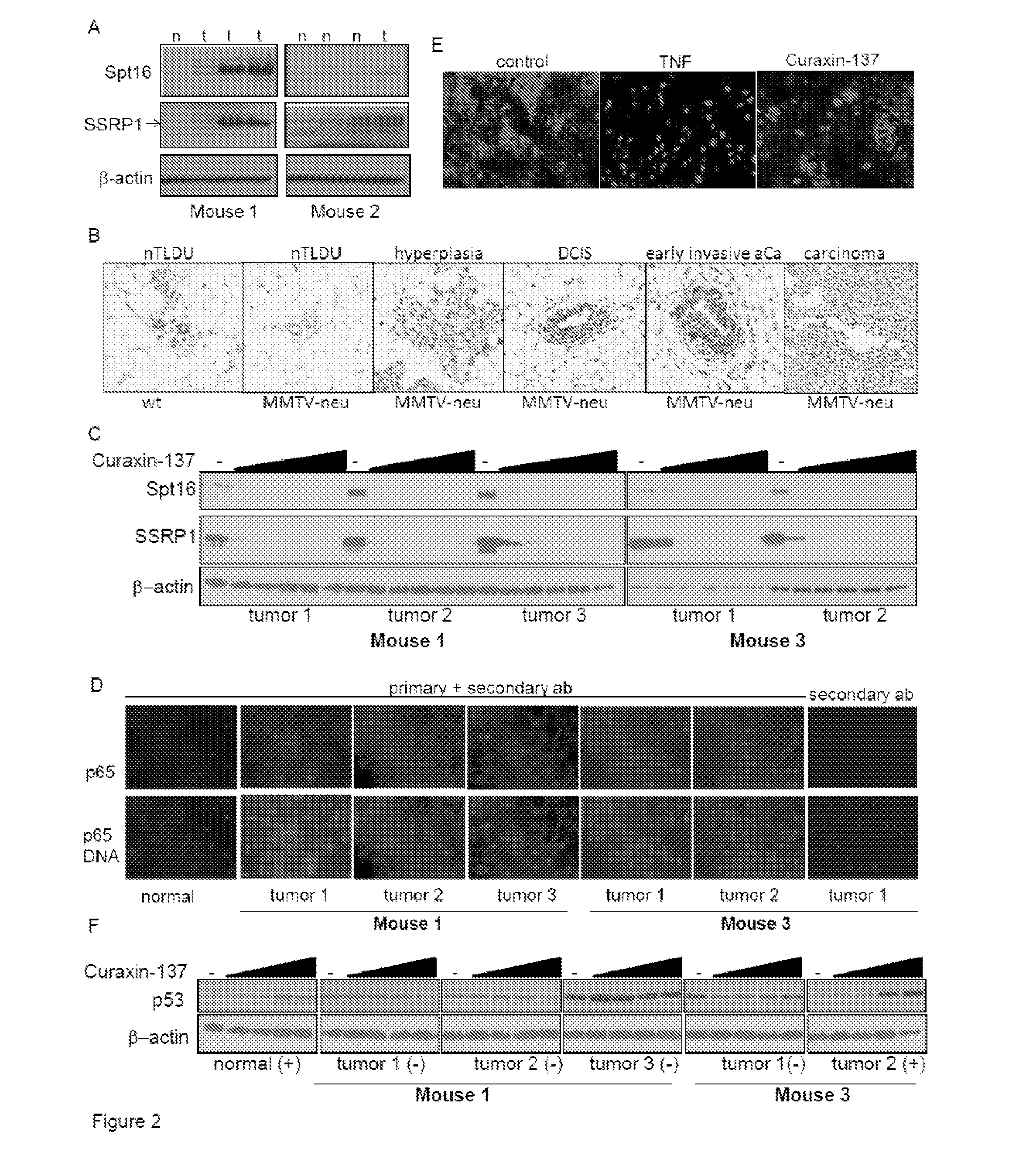 Curaxins for use in treating breast cancer and method for identifing patients likely to respond