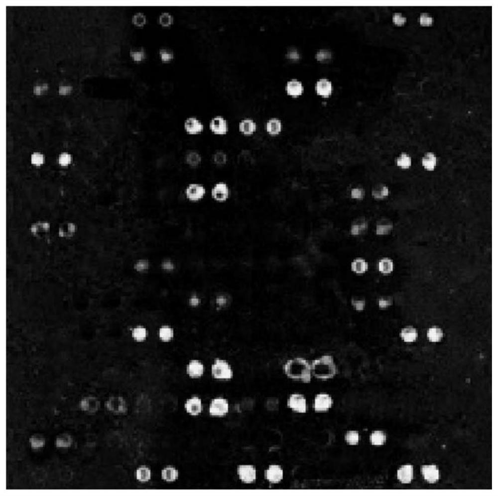 A kit and gene chip for detecting common mutations of atp7b gene