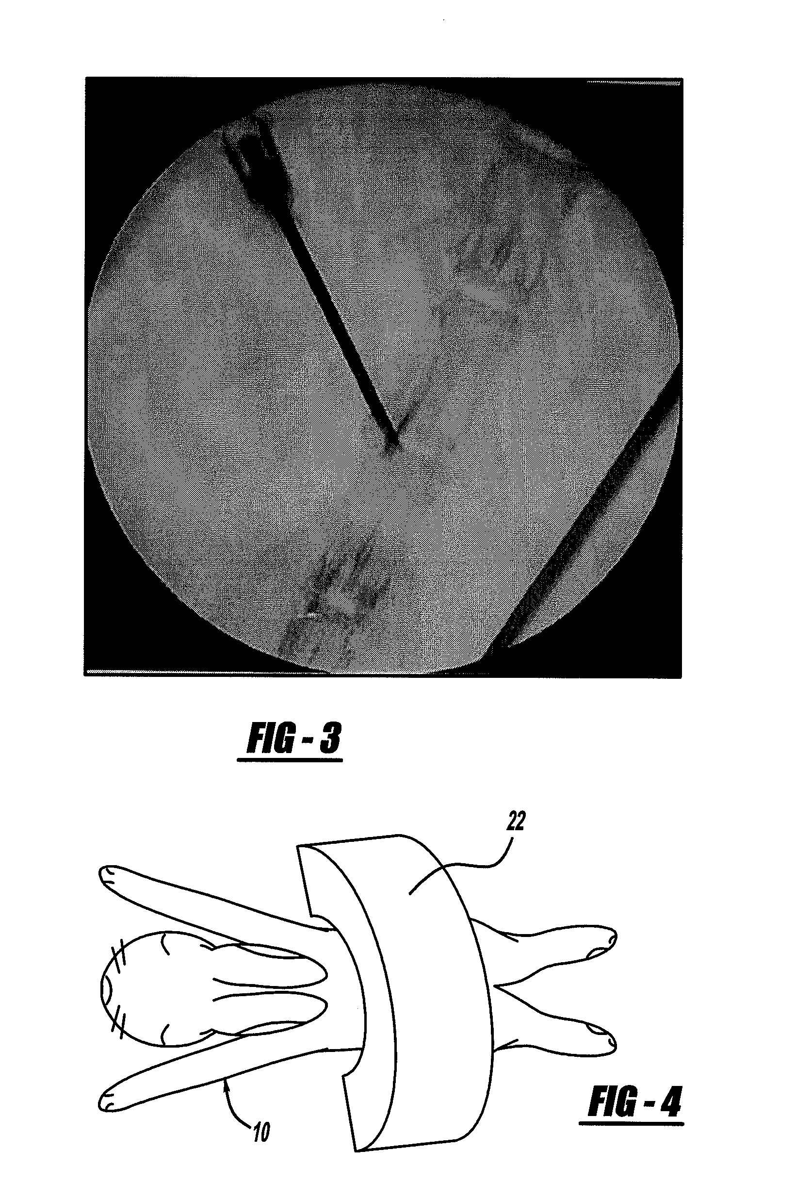 Method for Providing an InVivo Model of Disc Degeneration